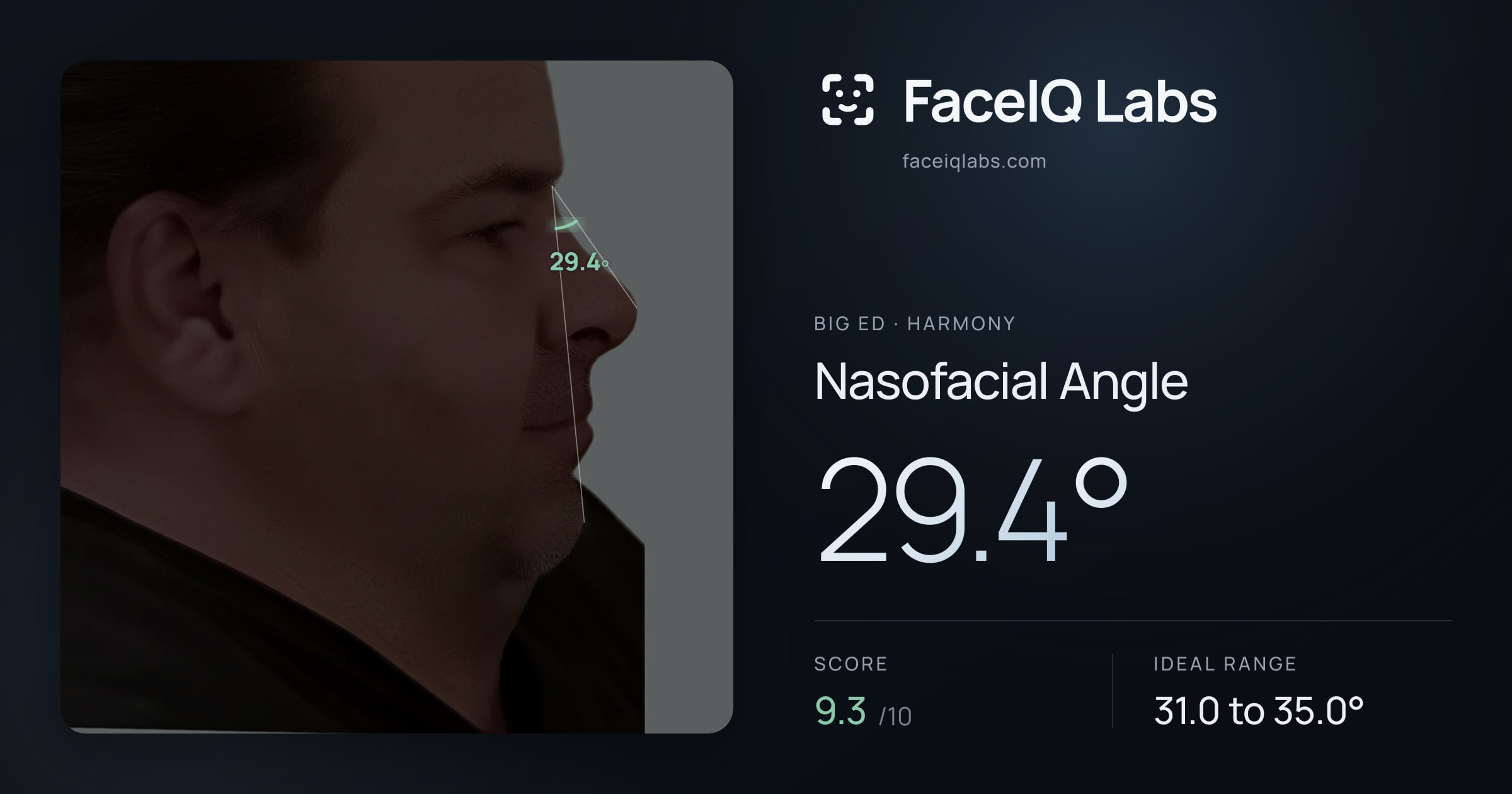 Big Ed Nasofacial Angle: 29.4°, drawn on the photo