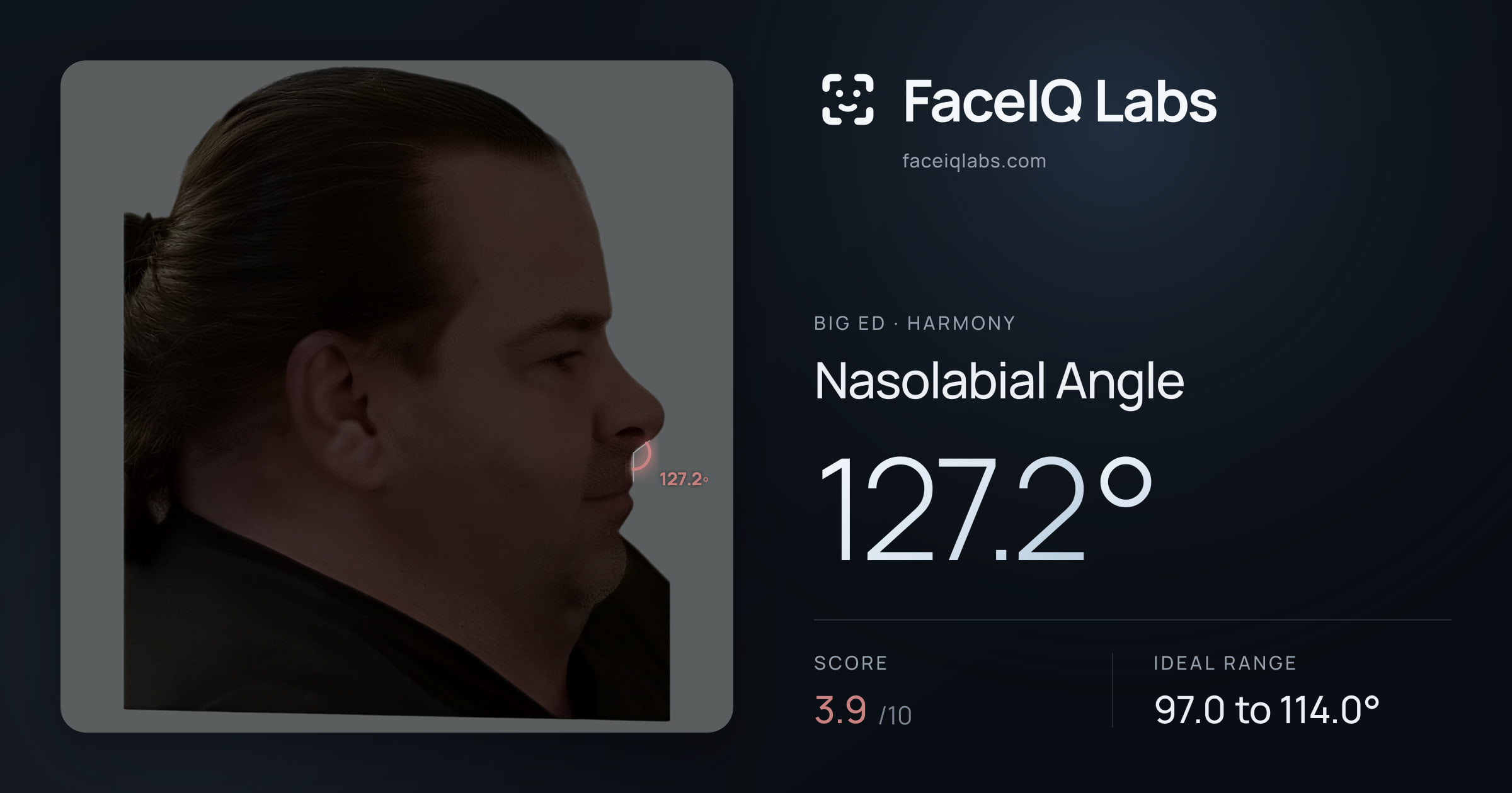 Big Ed Nasolabial Angle: 127.2°, drawn on the photo