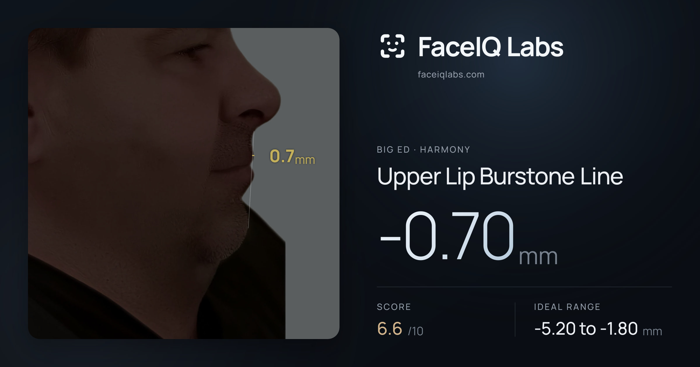 Big Ed Upper Lip Burstone Line: -0.70mm, drawn on the photo
