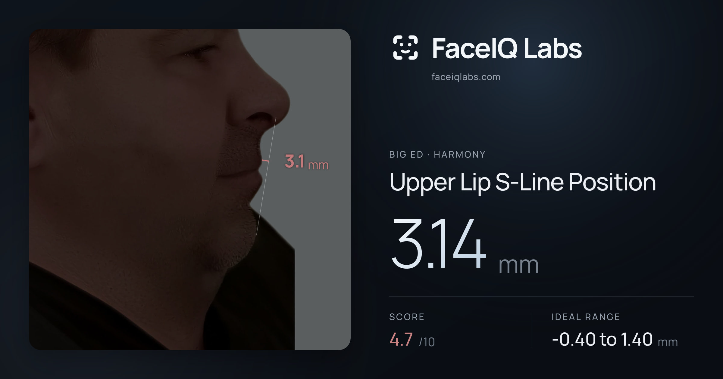 Big Ed Upper Lip S-Line Position: 3.14mm, drawn on the photo
