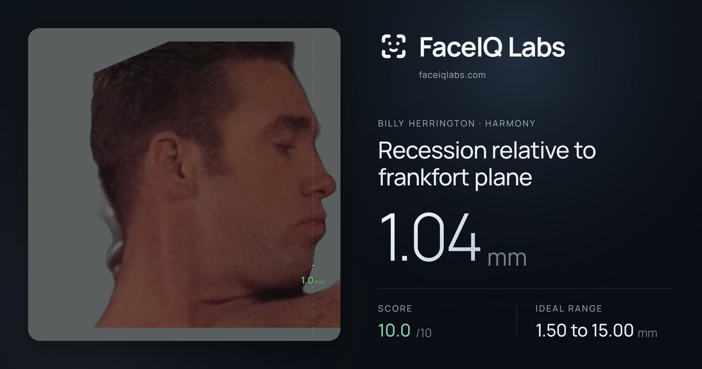 Billy Herrington Recession relative to frankfort plane: 1.04mm, drawn on the photo