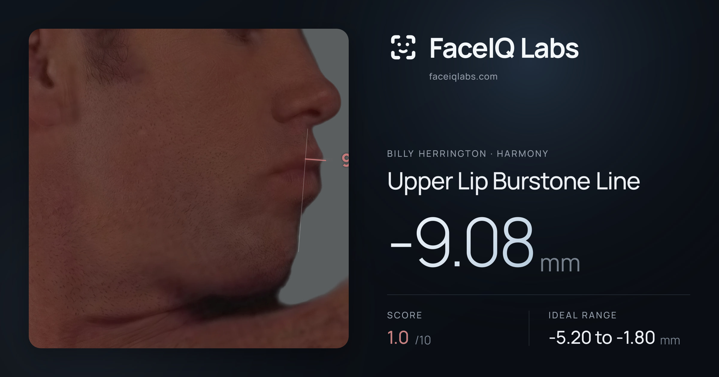 Billy Herrington Upper Lip Burstone Line: -9.08mm, drawn on the photo