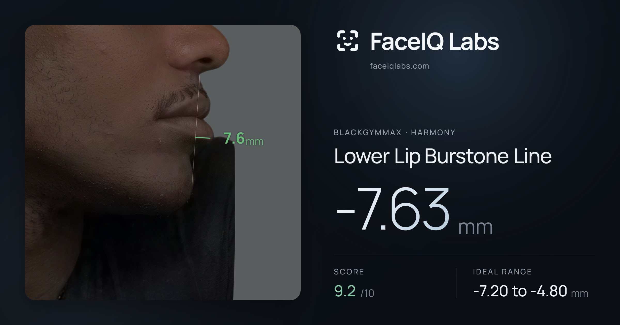 Blackgymmax Lower Lip Burstone Line: -7.63mm, drawn on the photo
