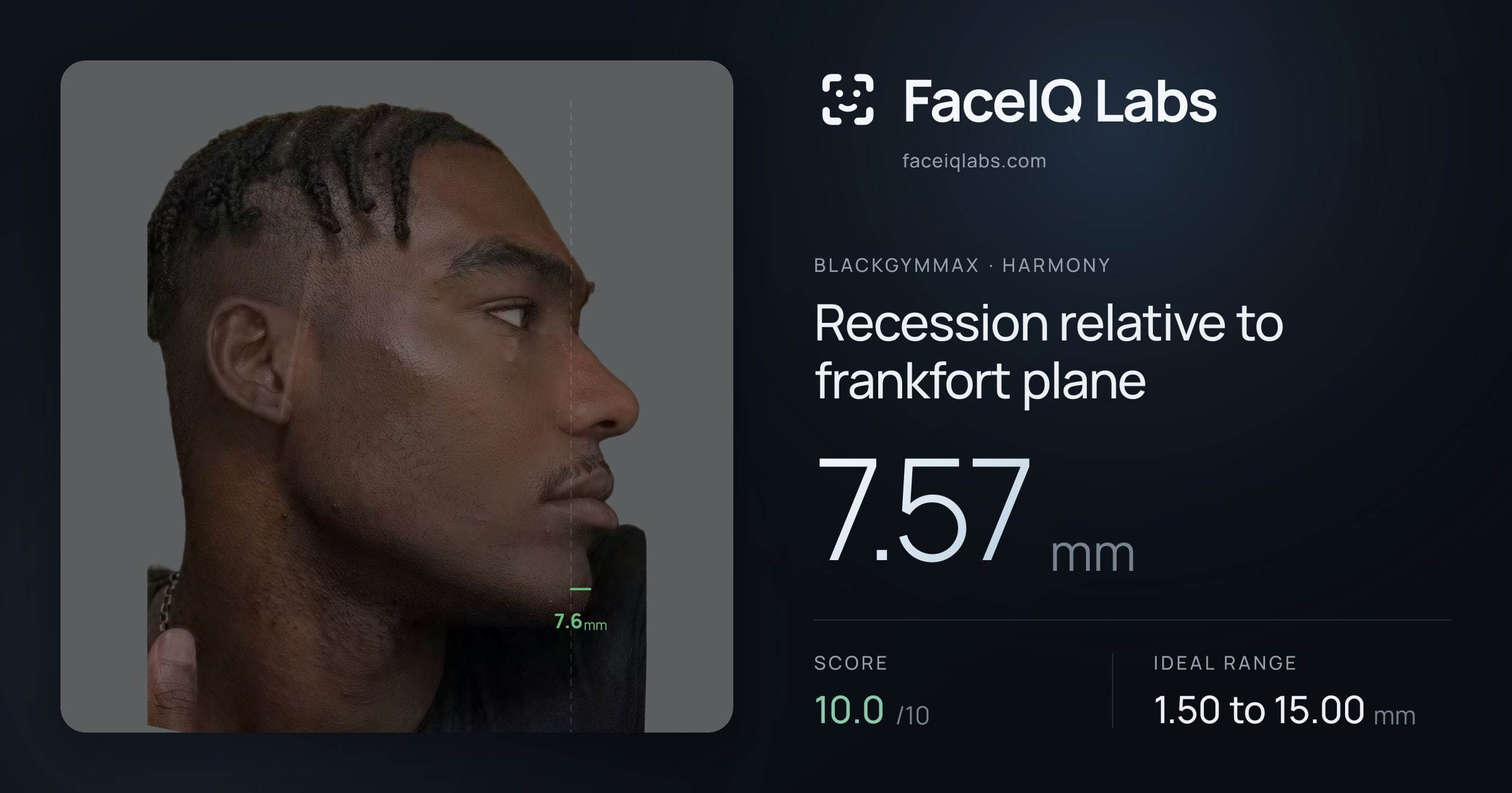 Blackgymmax Recession relative to frankfort plane: 7.57mm, drawn on the photo