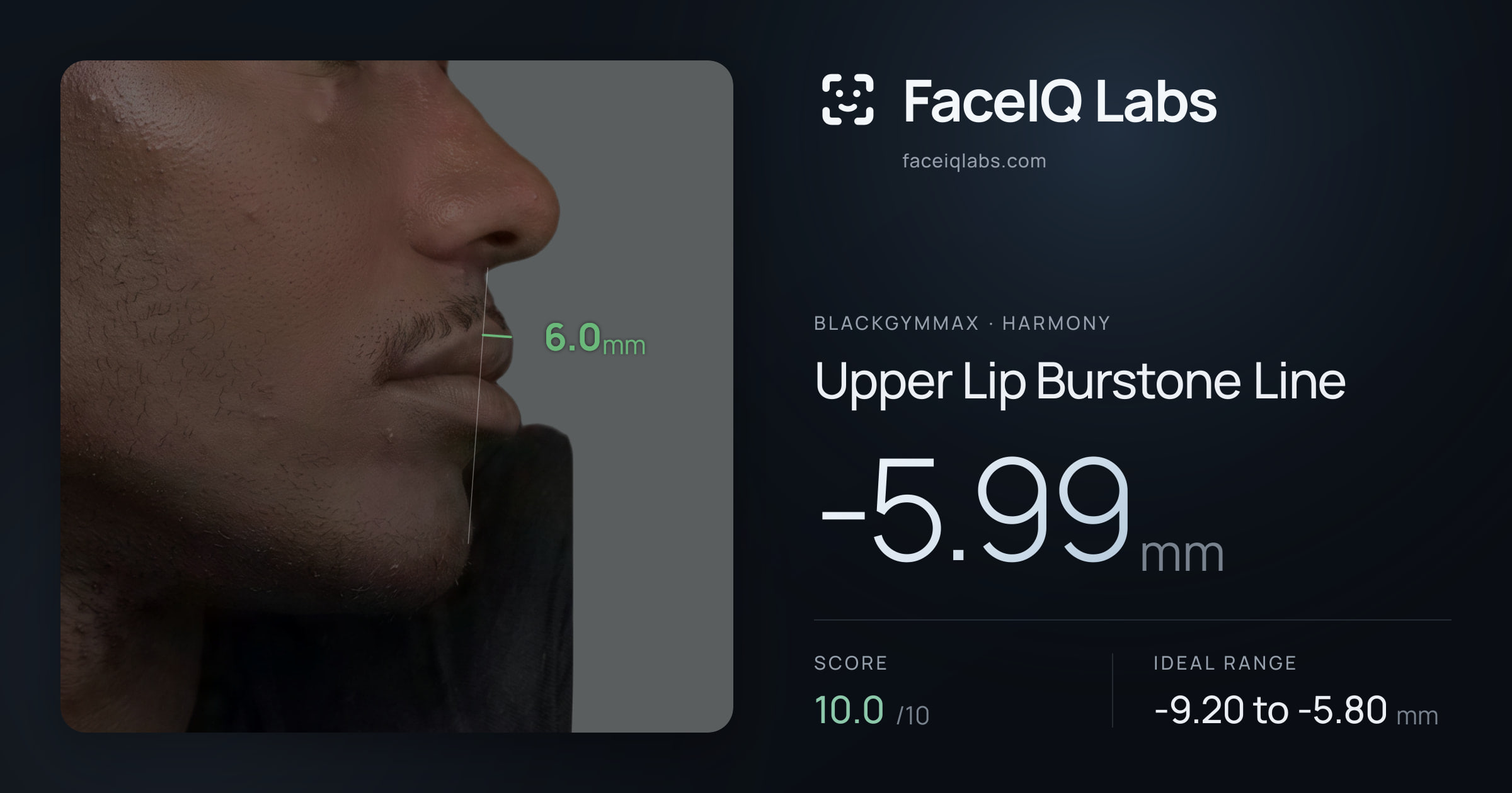 Blackgymmax Upper Lip Burstone Line: -5.99mm, drawn on the photo