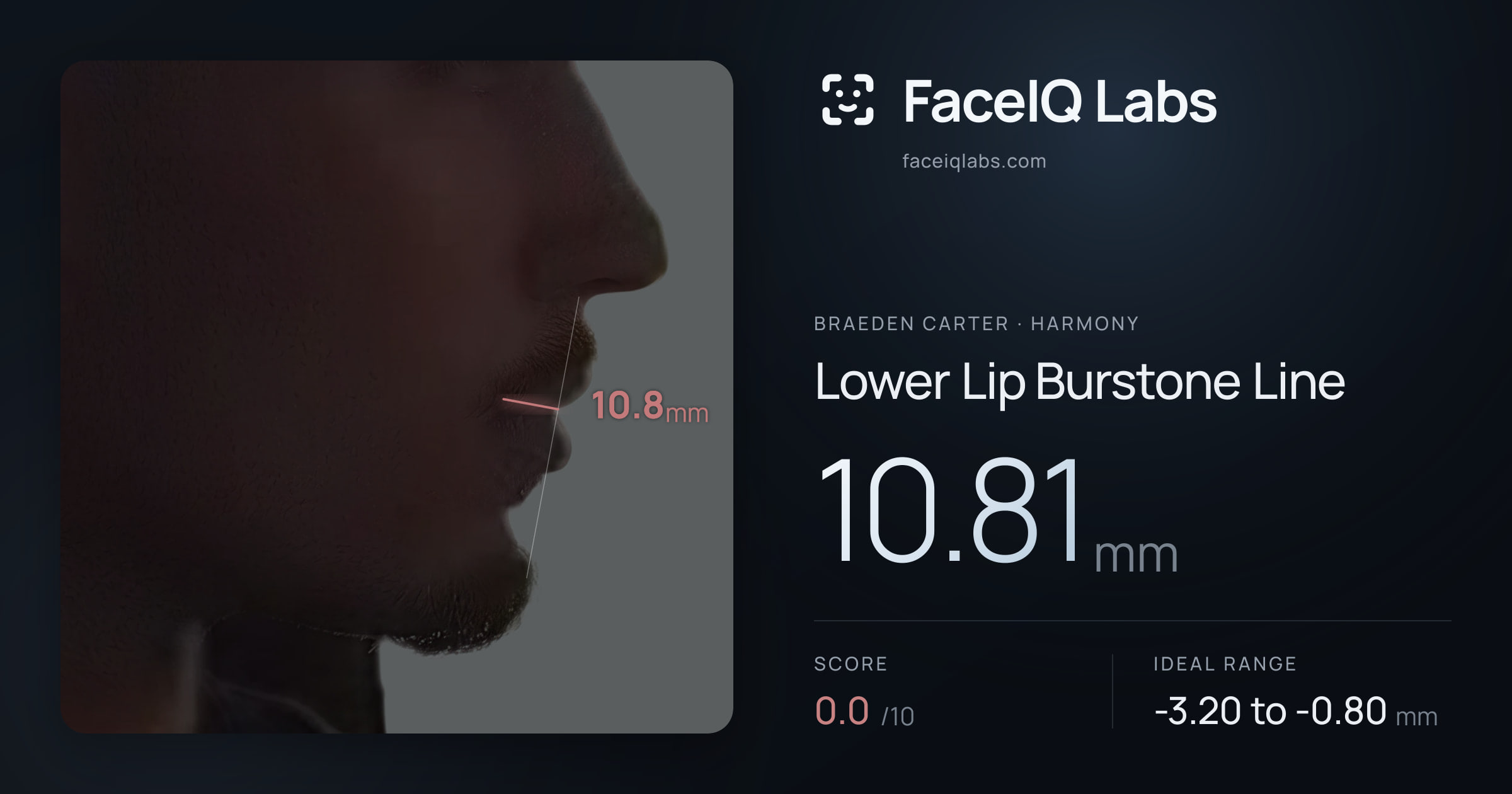 Braeden Carter Lower Lip Burstone Line: 10.81mm, drawn on the photo