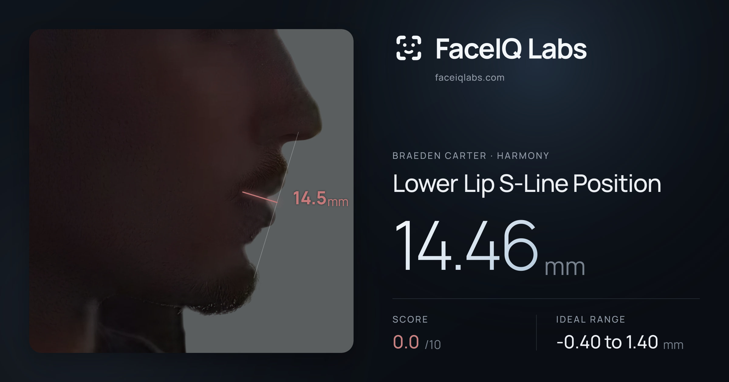 Braeden Carter Lower Lip S-Line Position: 14.46mm, drawn on the photo