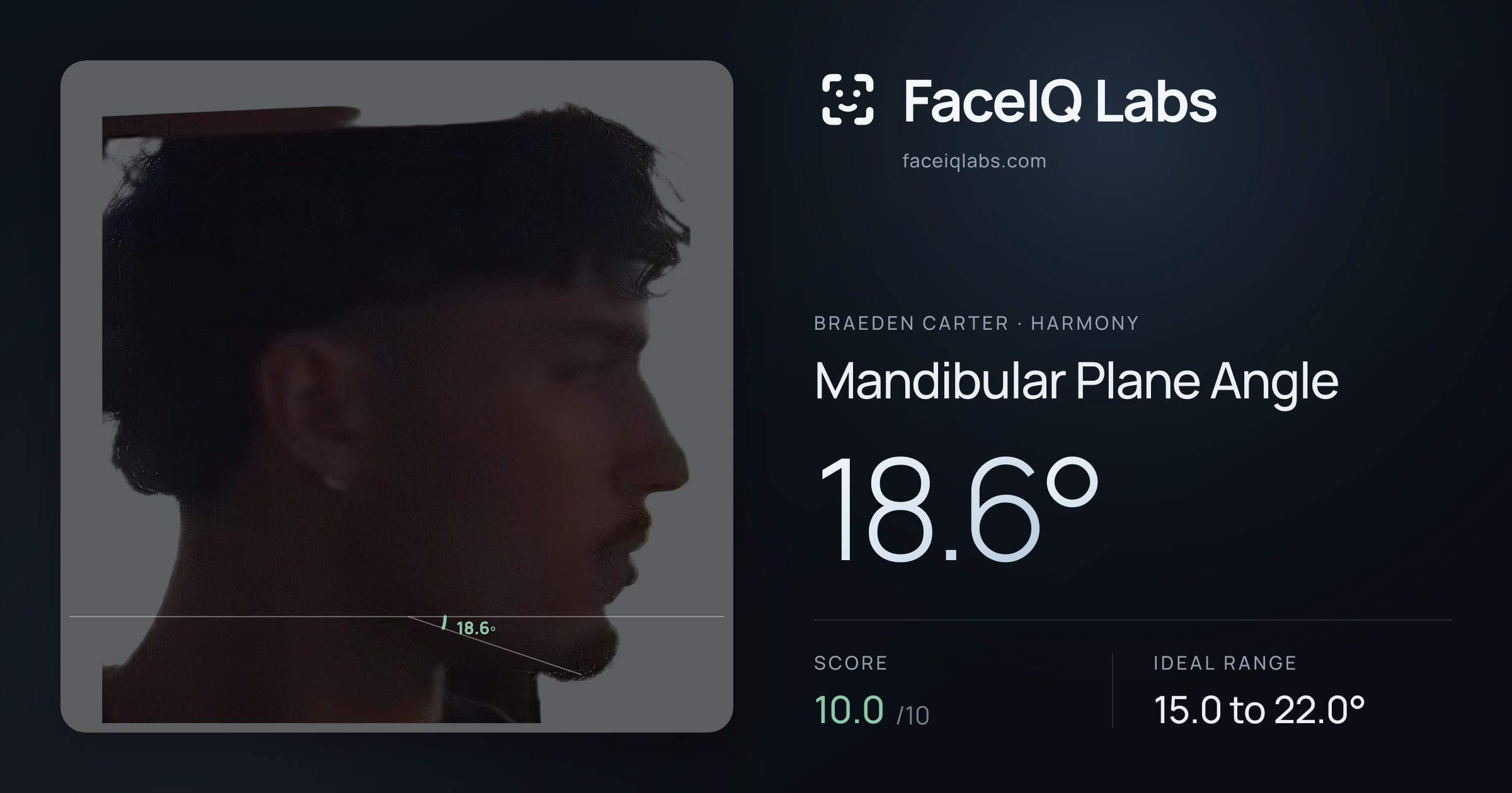 Braeden Carter Mandibular Plane Angle: 18.6°, drawn on the photo