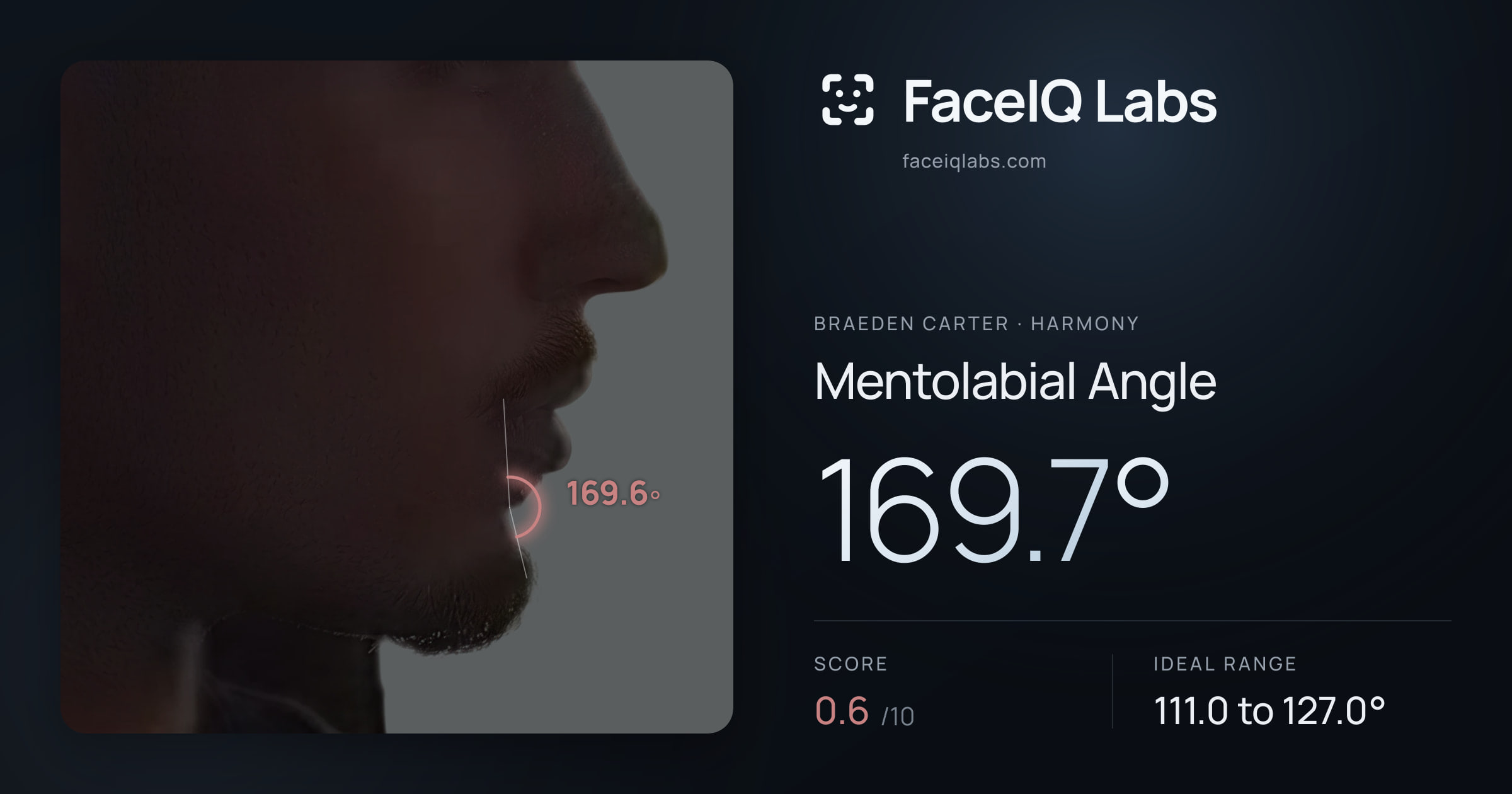 Braeden Carter Mentolabial Angle: 169.7°, drawn on the photo