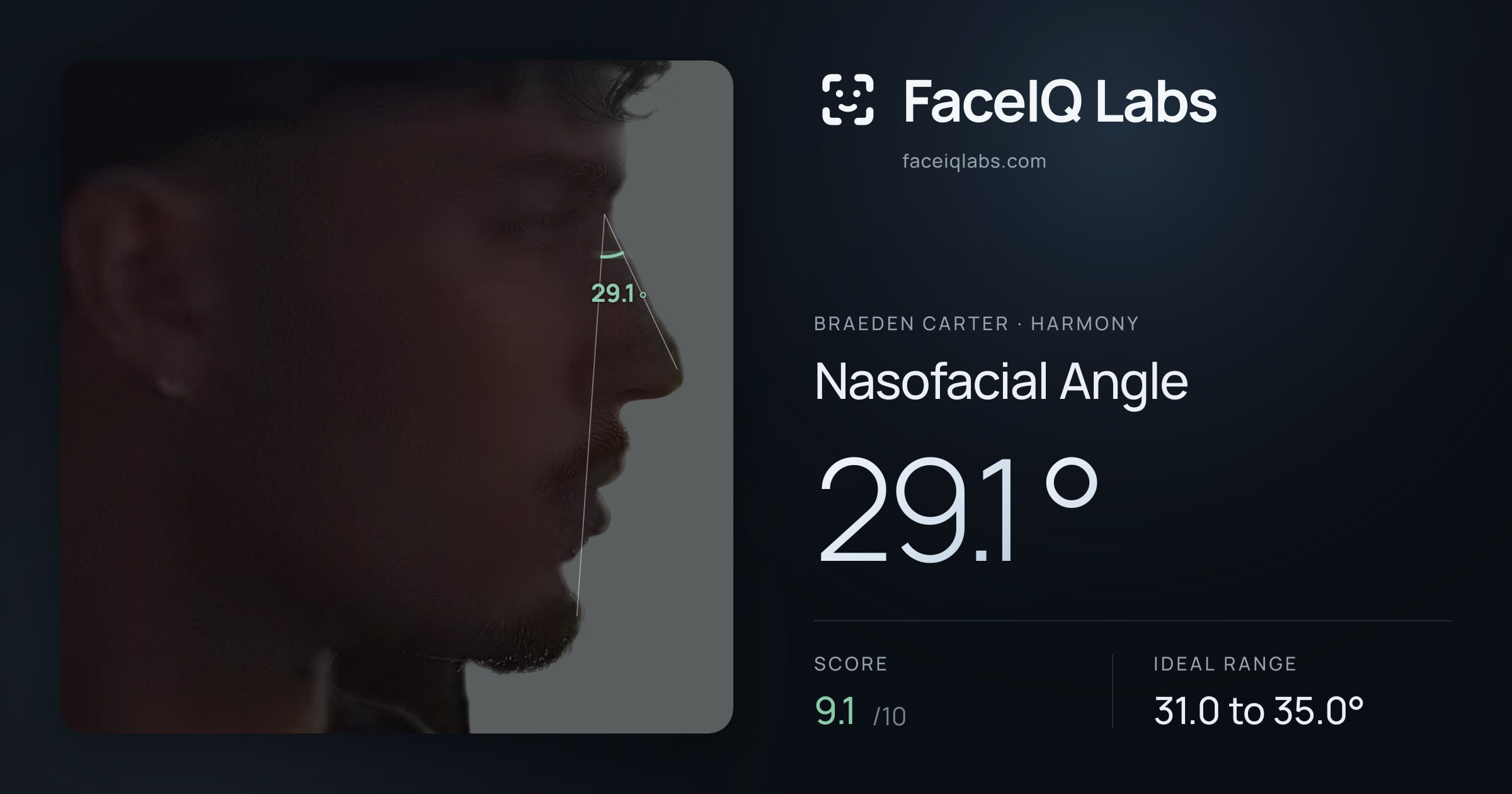 Braeden Carter Nasofacial Angle: 29.1°, drawn on the photo