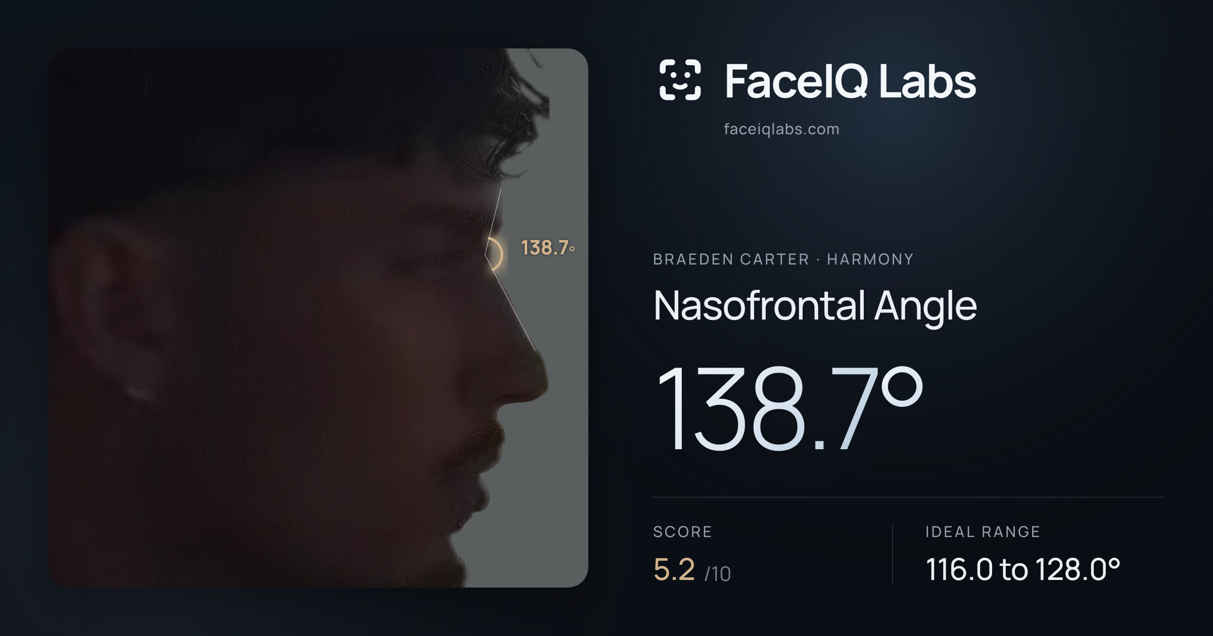 Braeden Carter Nasofrontal Angle: 138.7°, drawn on the photo