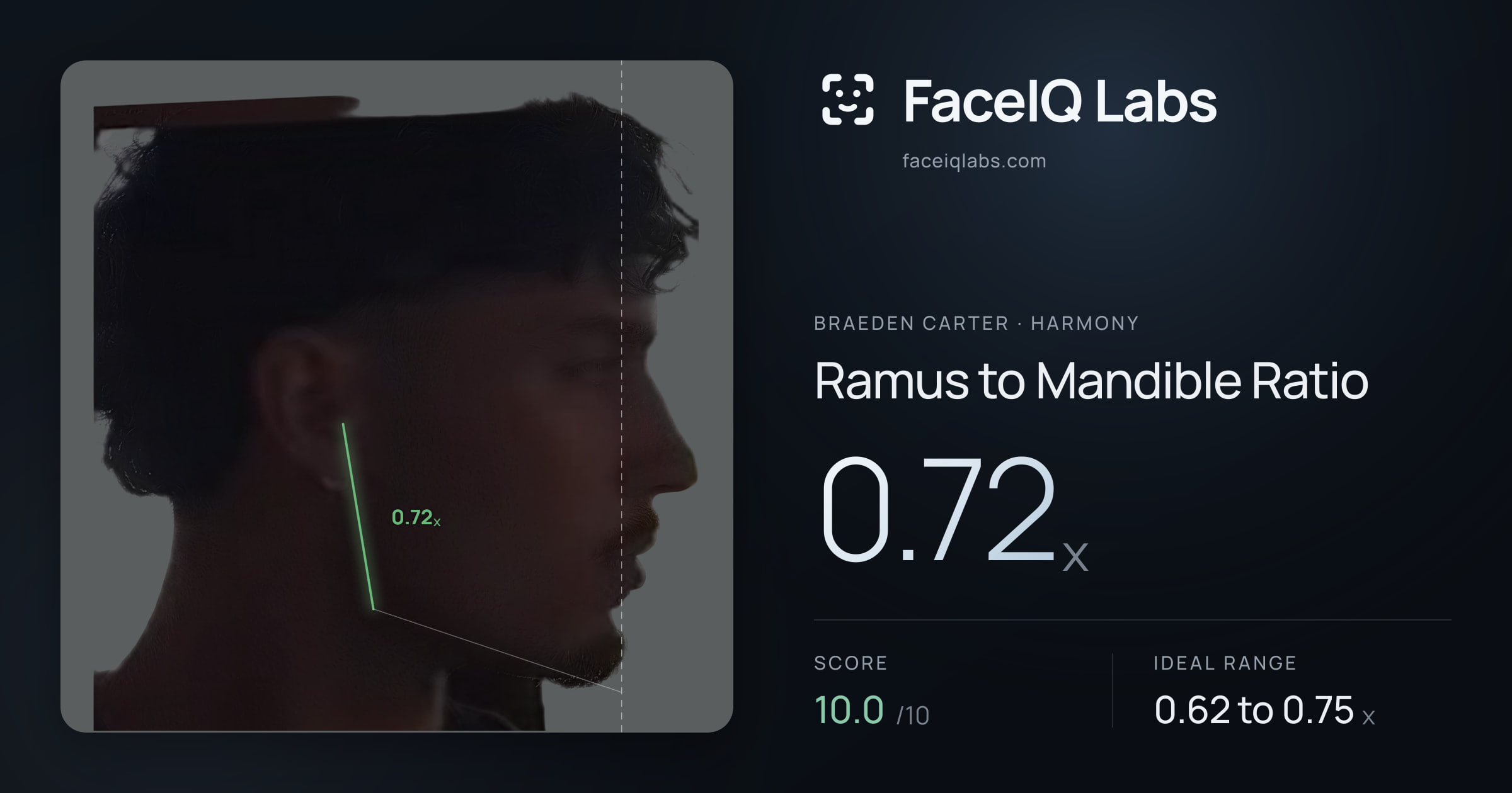 Braeden Carter Ramus to Mandible Ratio: 0.72x, drawn on the photo