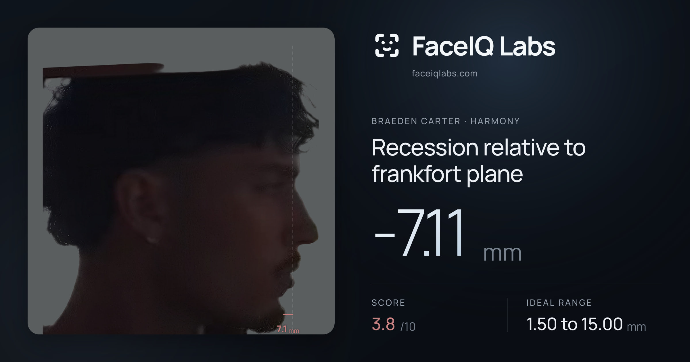 Braeden Carter Recession relative to frankfort plane: -7.11mm, drawn on the photo