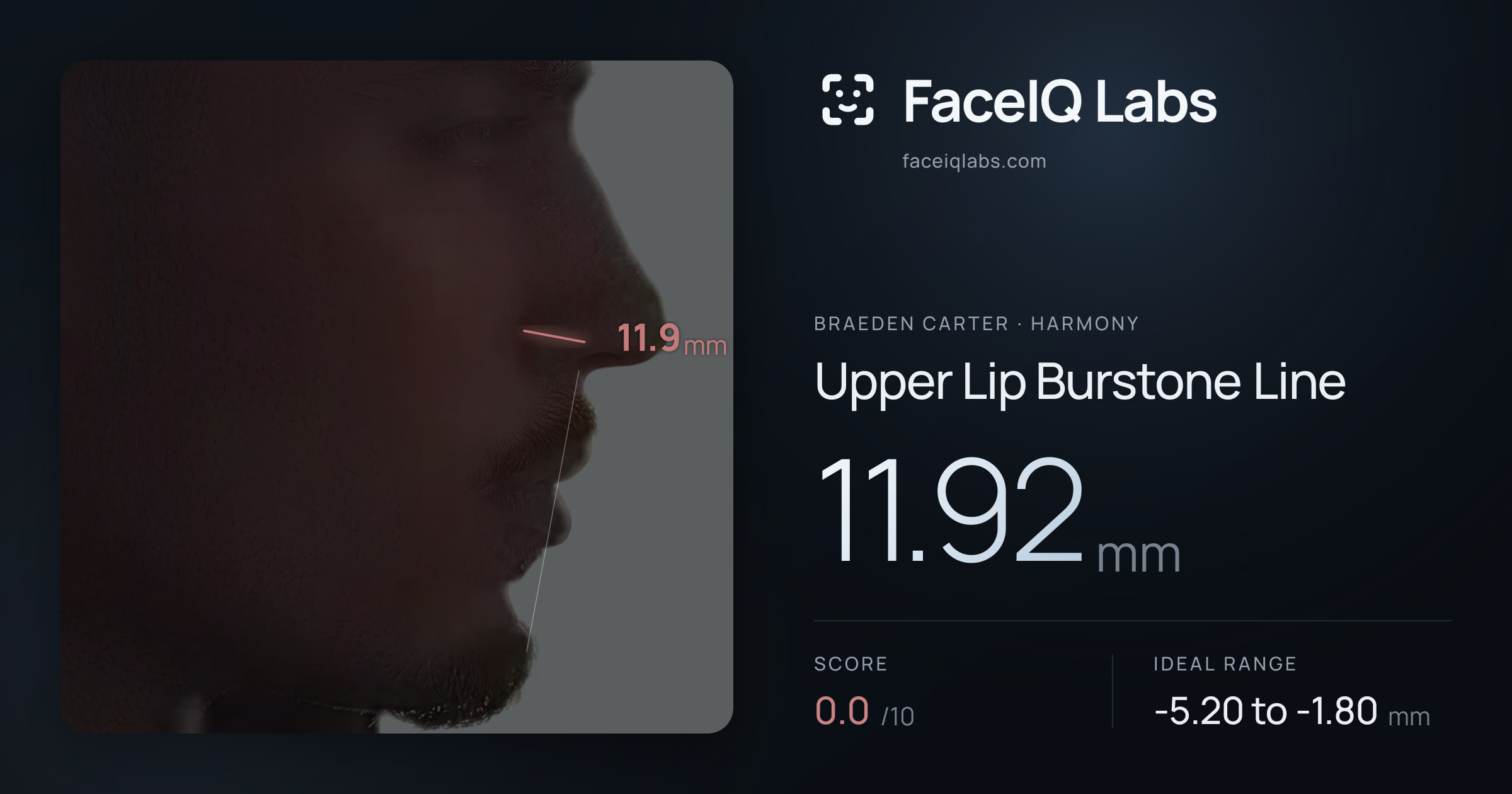 Braeden Carter Upper Lip Burstone Line: 11.92mm, drawn on the photo