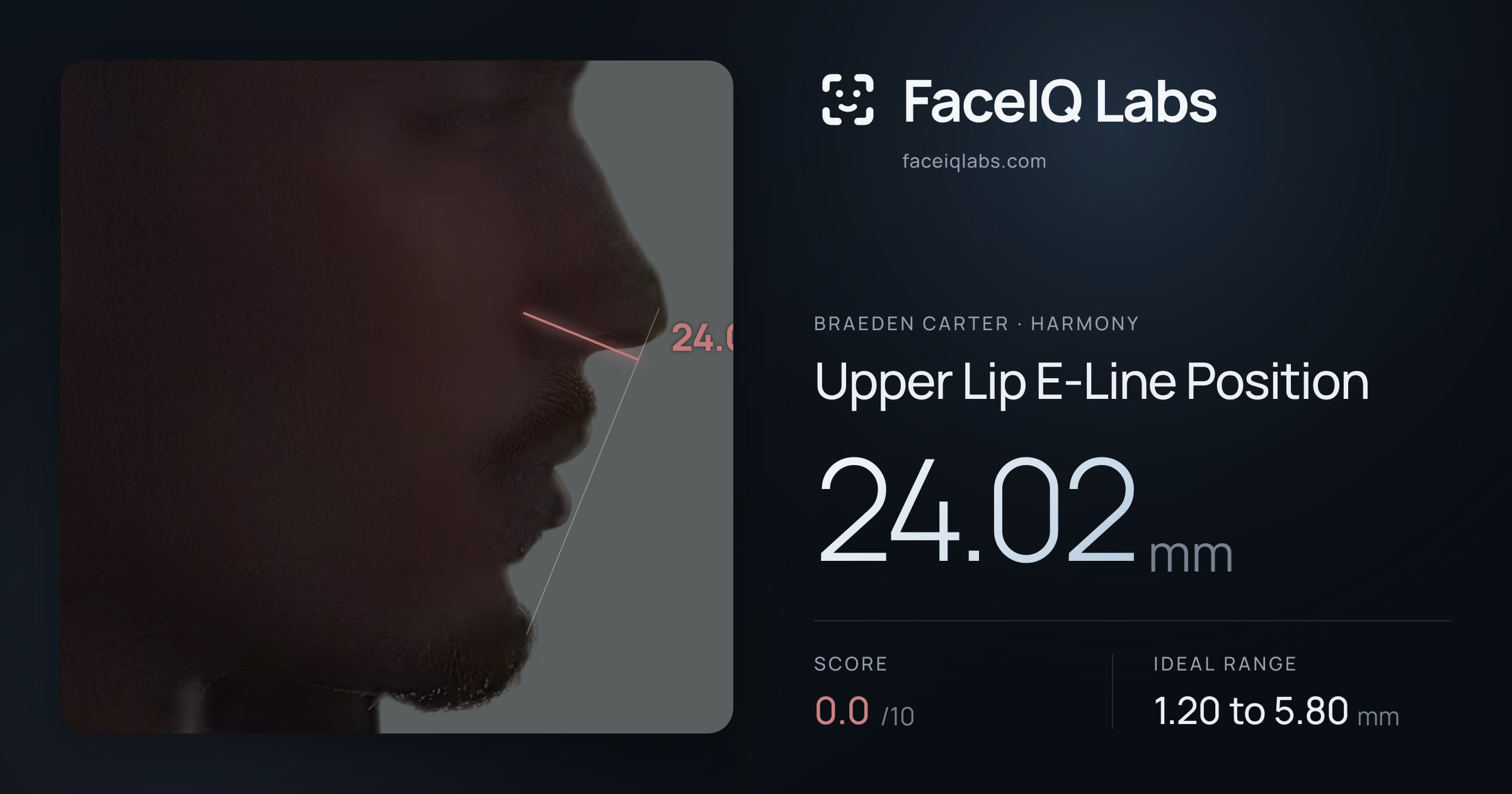 Braeden Carter Upper Lip E-Line Position: 24.02mm, drawn on the photo