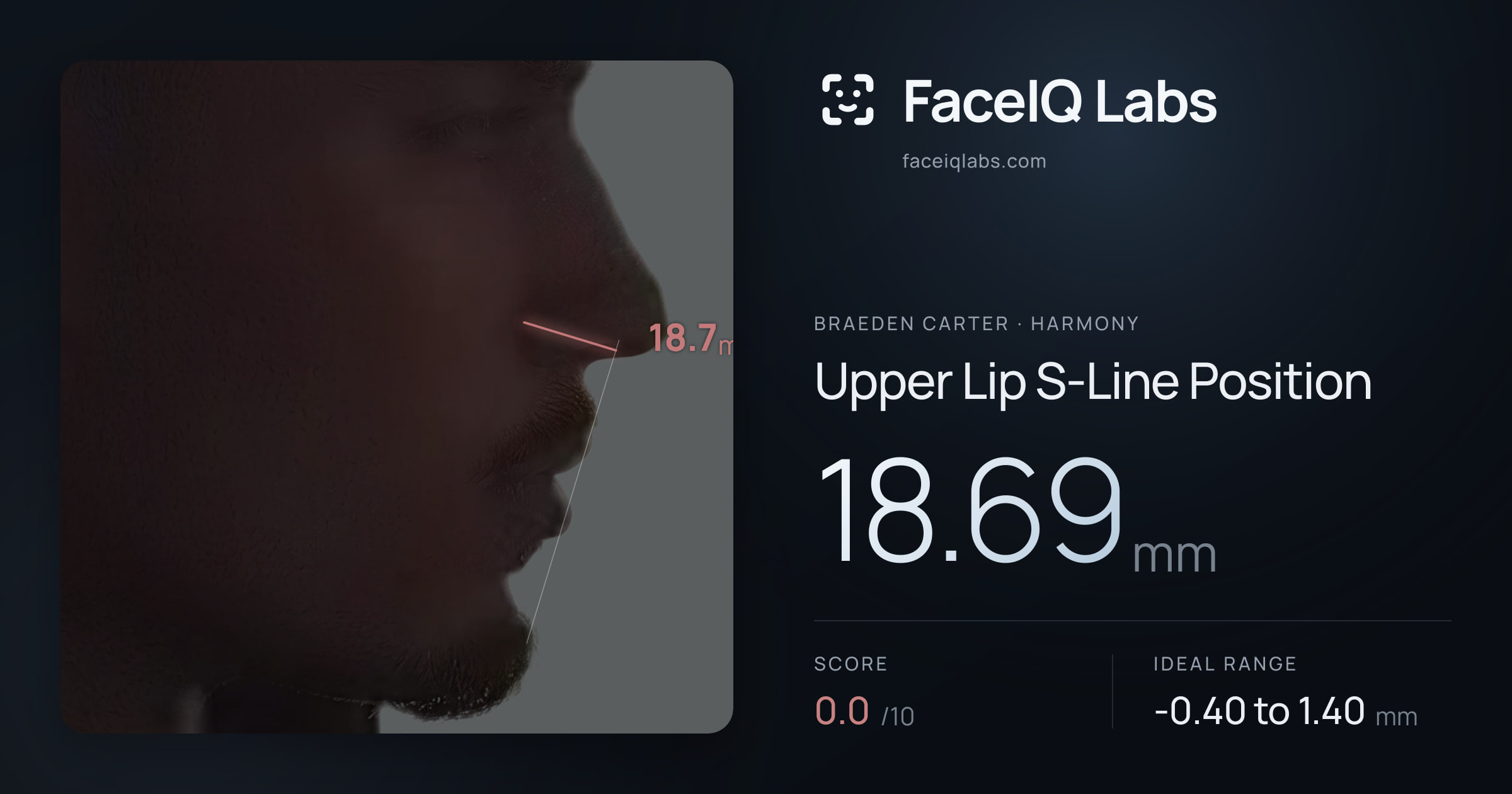 Braeden Carter Upper Lip S-Line Position: 18.69mm, drawn on the photo