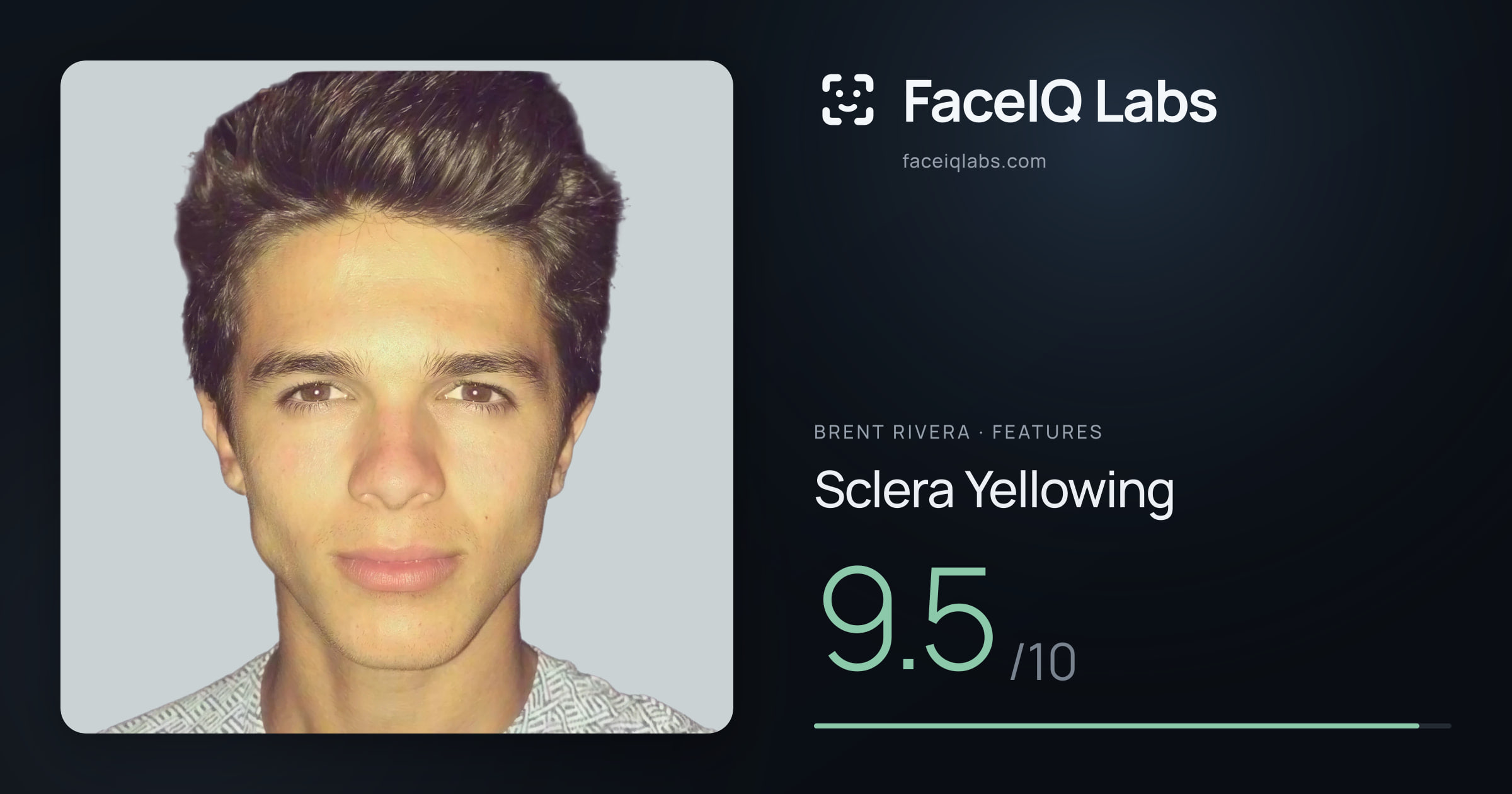 Brent Rivera Sclera Yellowing: 9.5/10, drawn on the photo