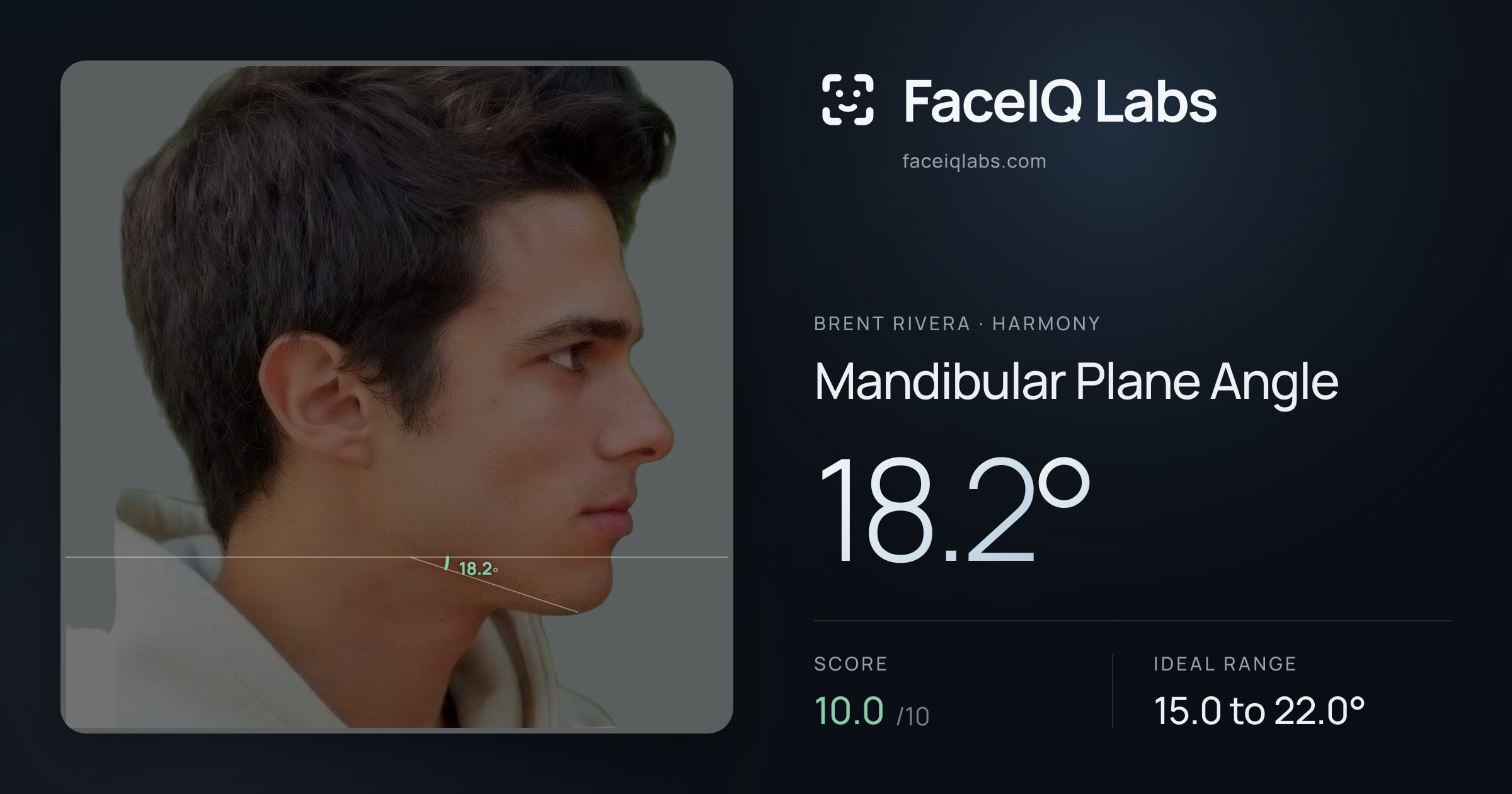 Brent Rivera Mandibular Plane Angle: 18.2°, drawn on the photo