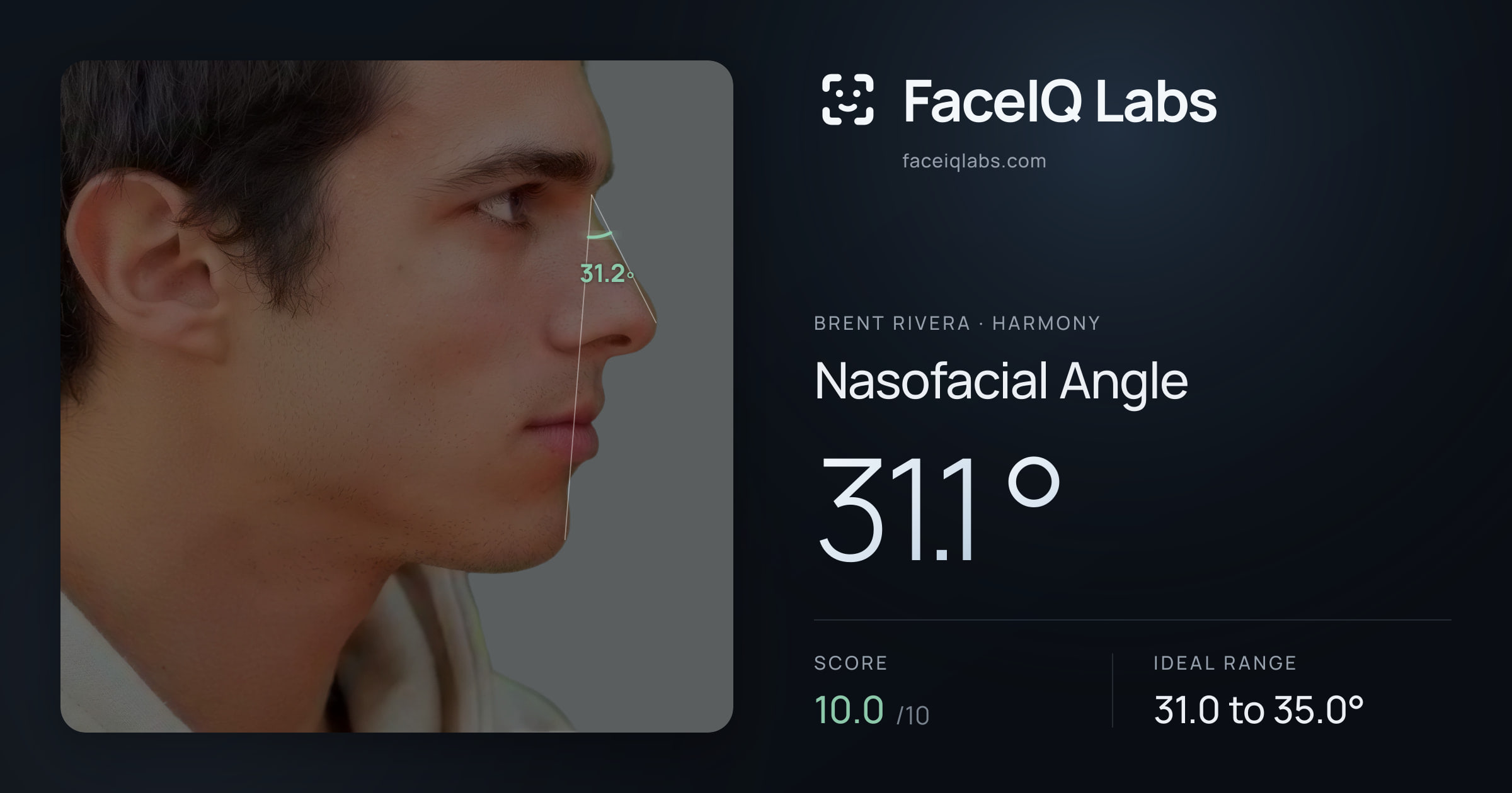 Brent Rivera Nasofacial Angle: 31.1°, drawn on the photo