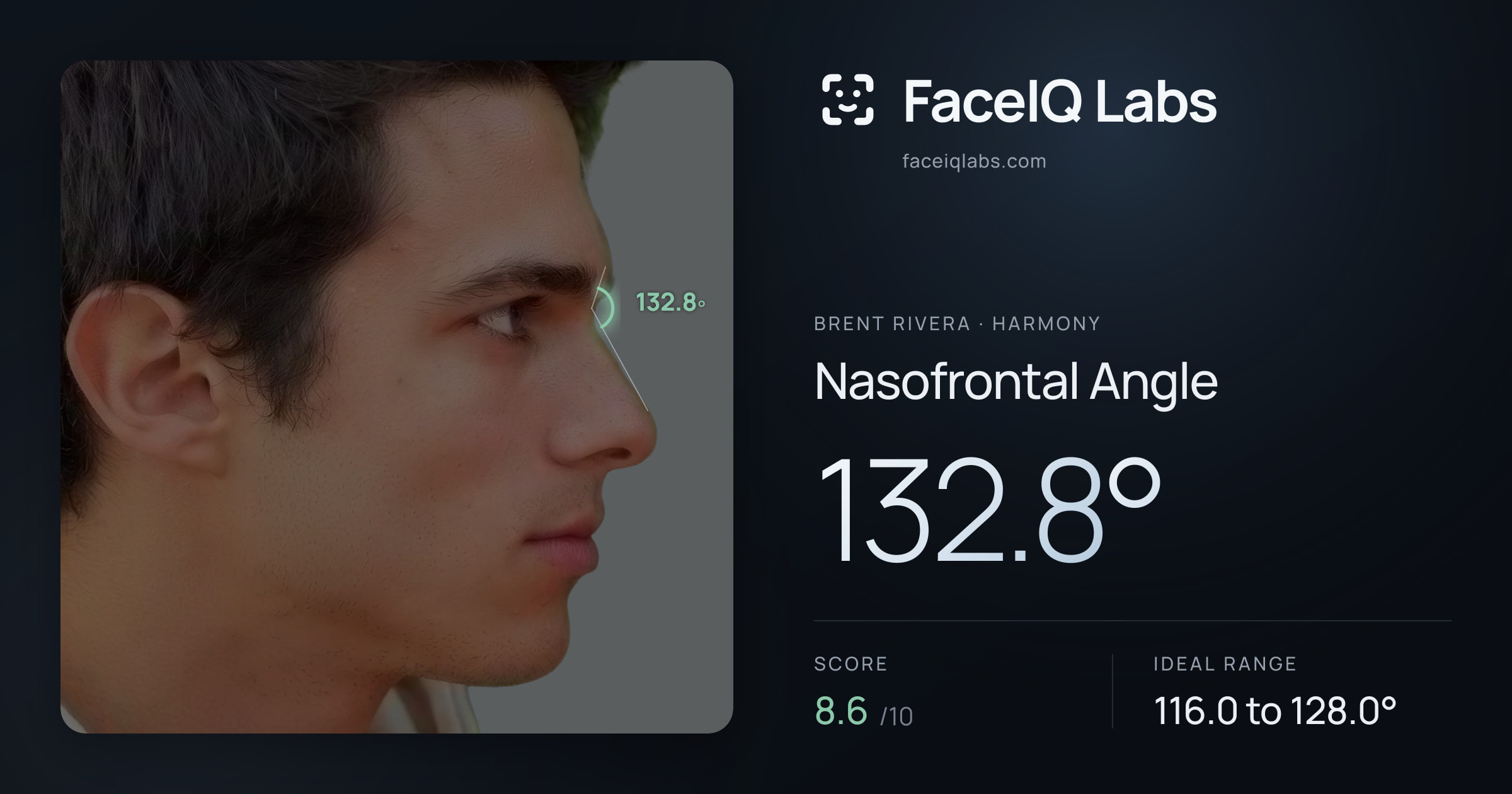 Brent Rivera Nasofrontal Angle: 132.8°, drawn on the photo