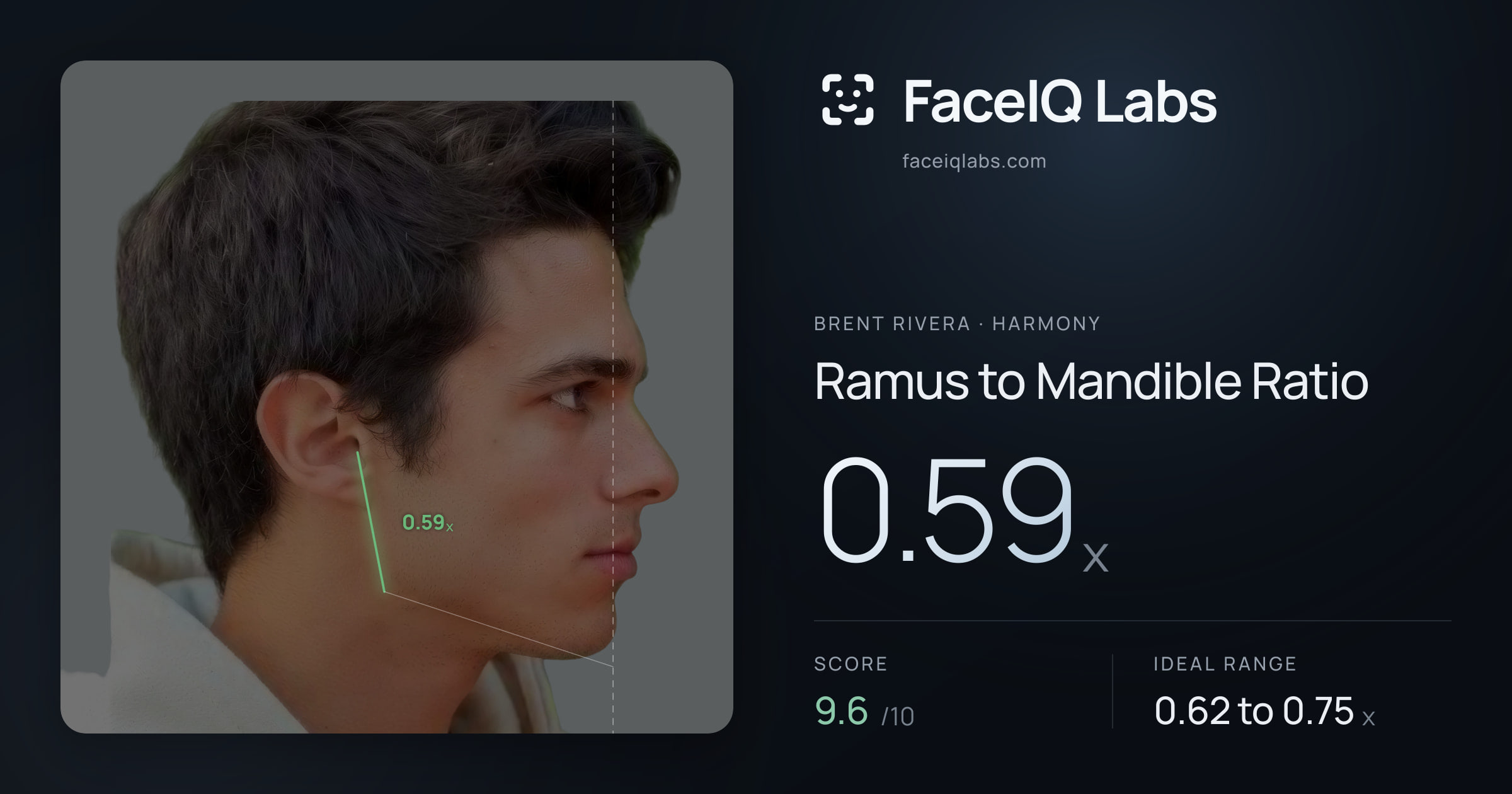 Brent Rivera Ramus to Mandible Ratio: 0.59x, drawn on the photo