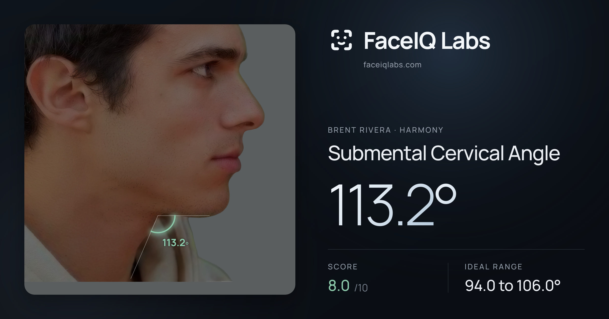 Brent Rivera Submental Cervical Angle: 113.2°, drawn on the photo