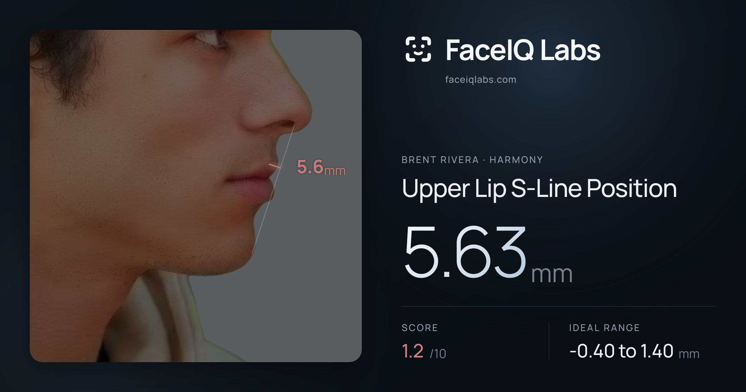 Brent Rivera Upper Lip S-Line Position: 5.63mm, drawn on the photo