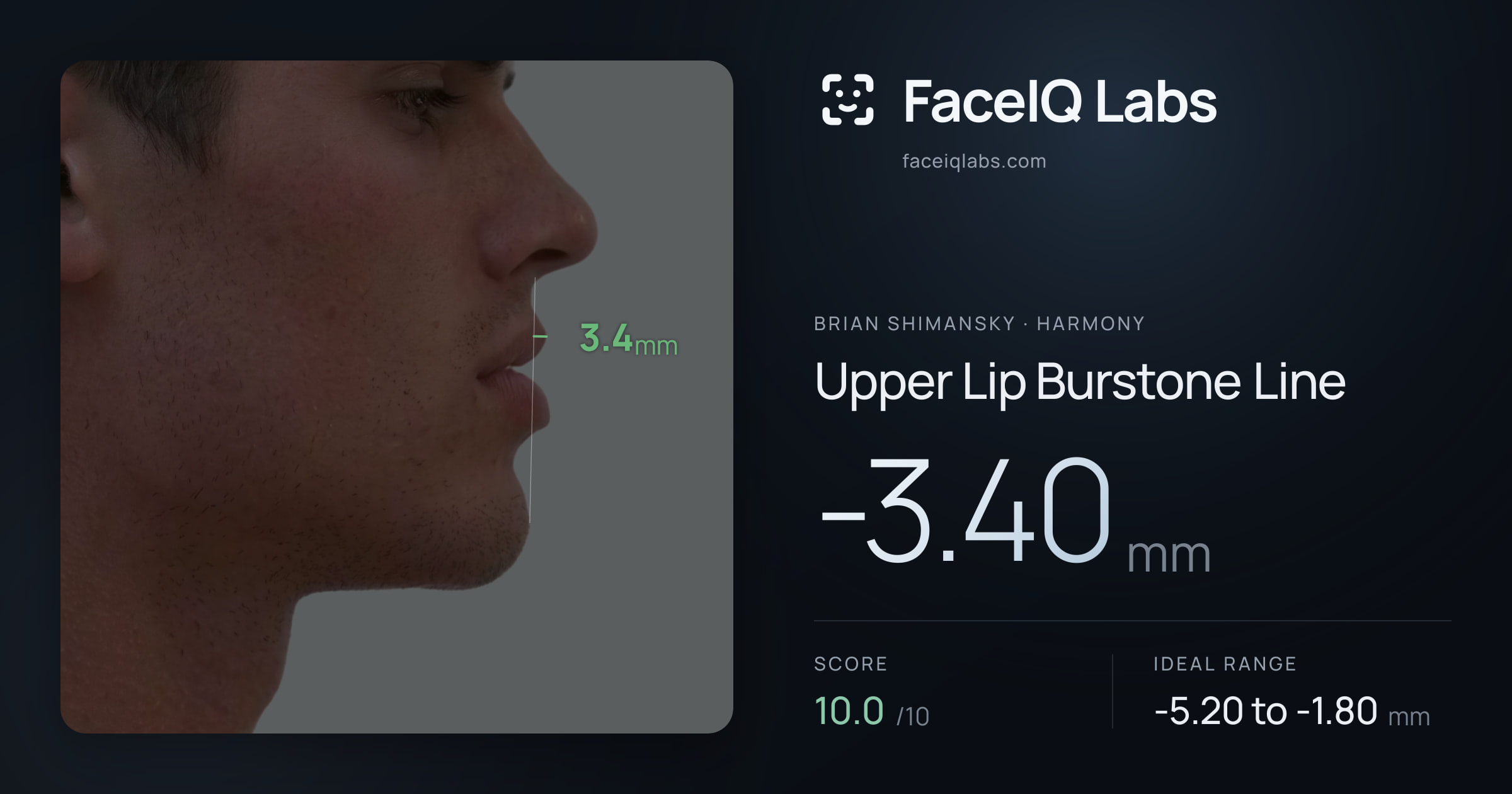 Brian Shimansky Upper Lip Burstone Line: -4.10mm, drawn on the photo