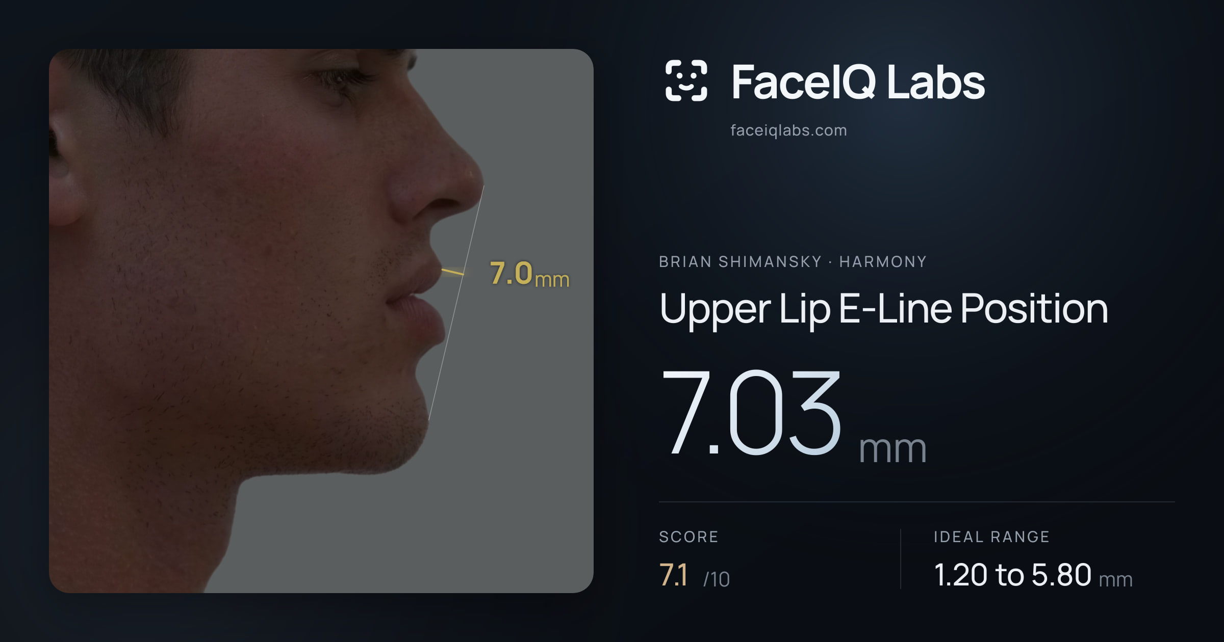 Brian Shimansky Upper Lip E-Line Position: 5.87mm, drawn on the photo