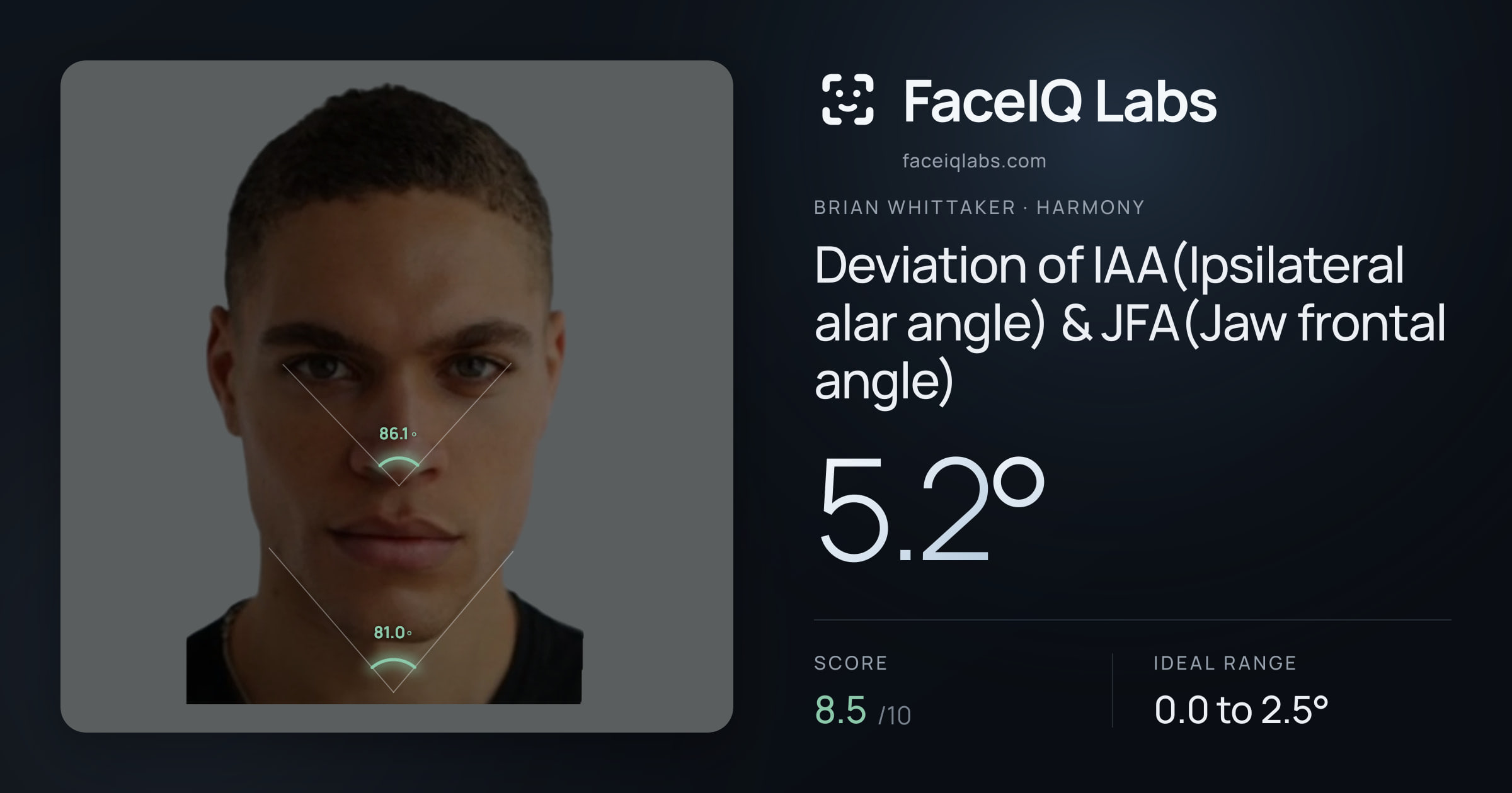 Brian Whittaker Deviation of IAA(Ipsilateral alar angle) & JFA(Jaw frontal angle): 5.2°, drawn on the photo
