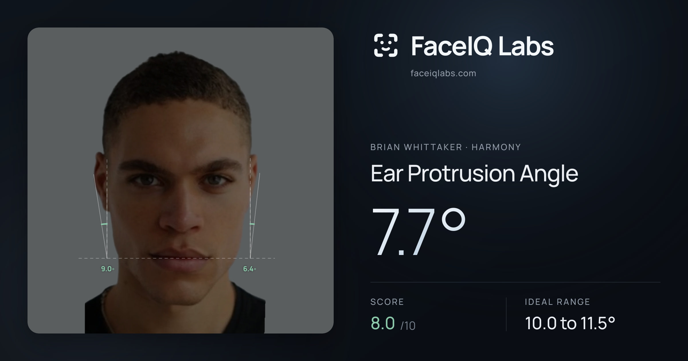 Brian Whittaker Ear Protrusion Angle: 7.7°, drawn on the photo
