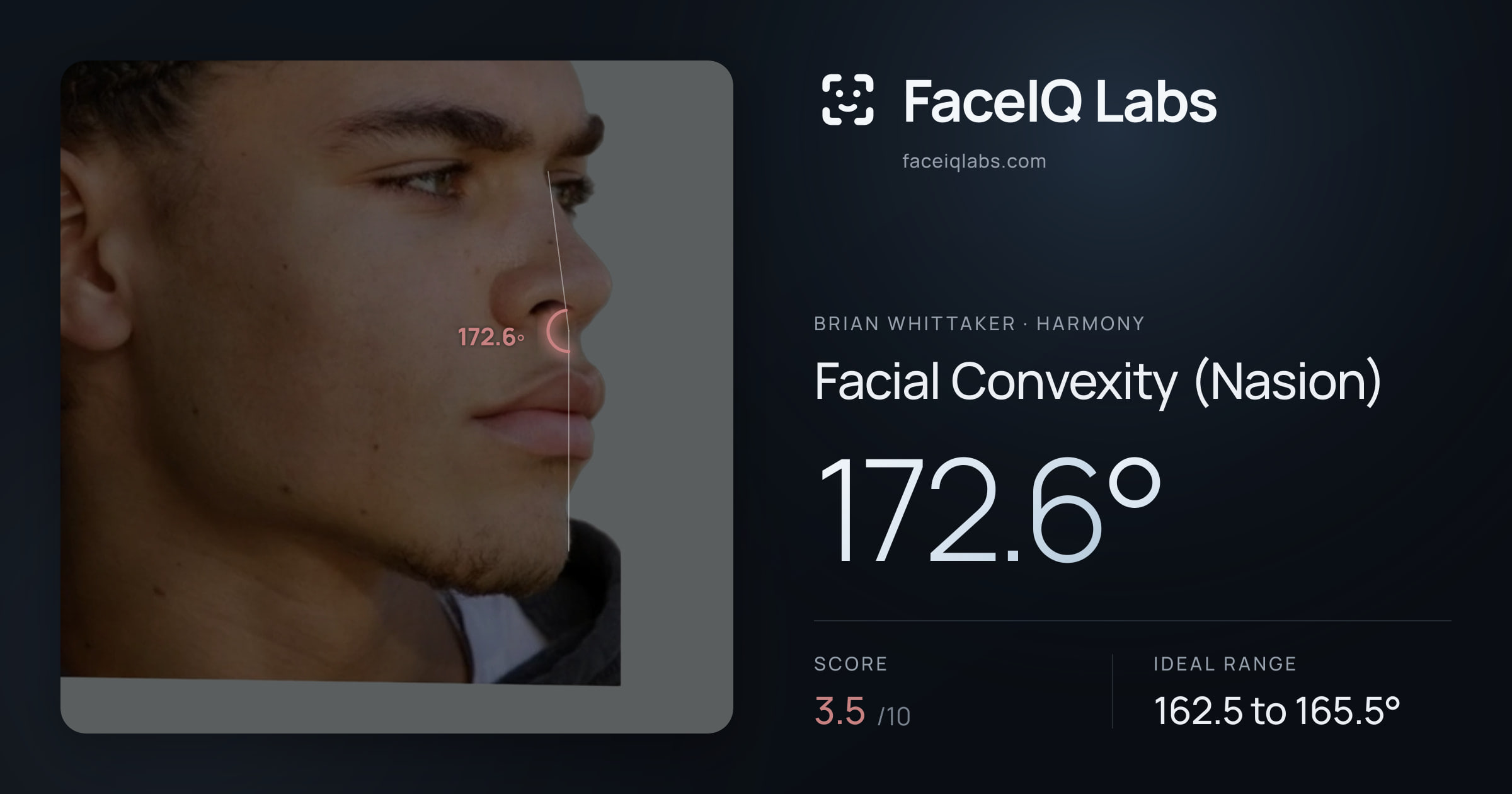 Brian Whittaker Facial Convexity (Nasion): 172.6°, drawn on the photo