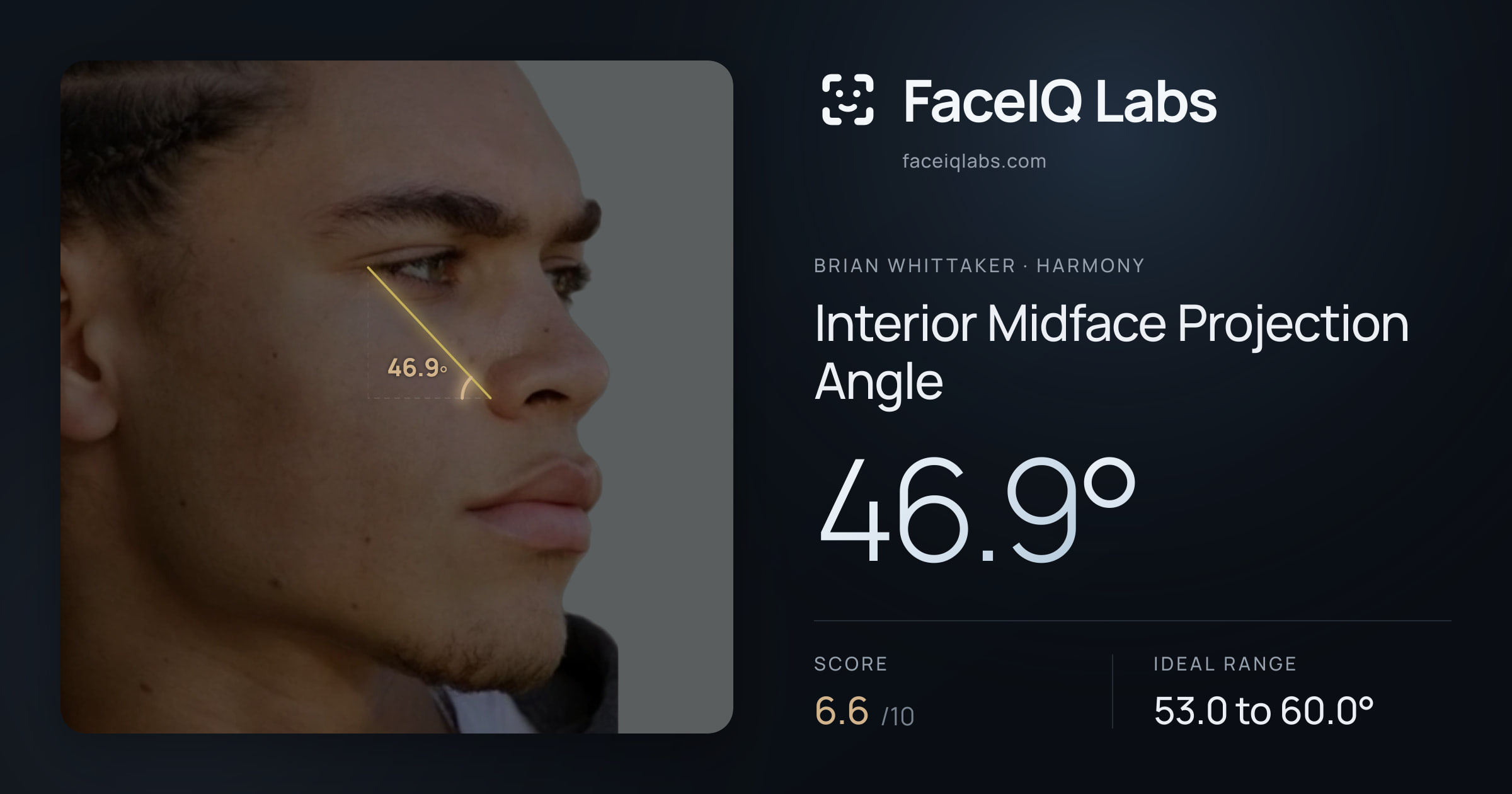 Brian Whittaker Interior Midface Projection Angle: 46.9°, drawn on the photo