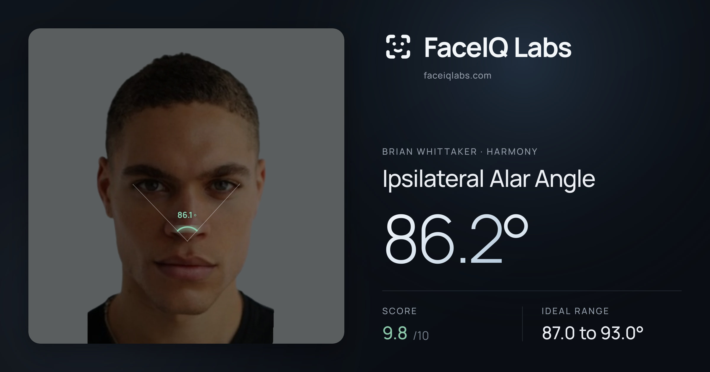 Brian Whittaker Ipsilateral Alar Angle: 86.2°, drawn on the photo