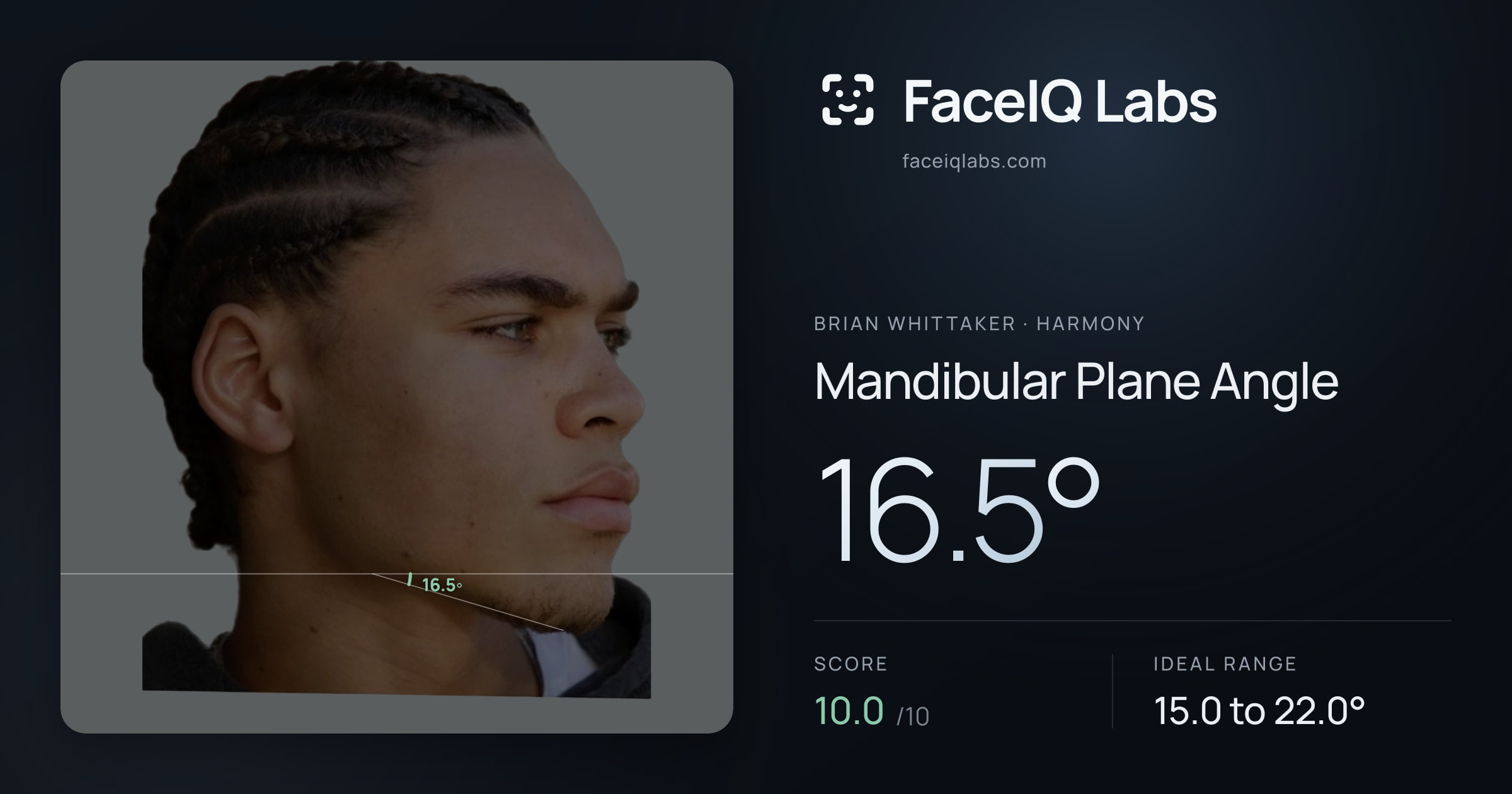 Brian Whittaker Mandibular Plane Angle: 16.5°, drawn on the photo