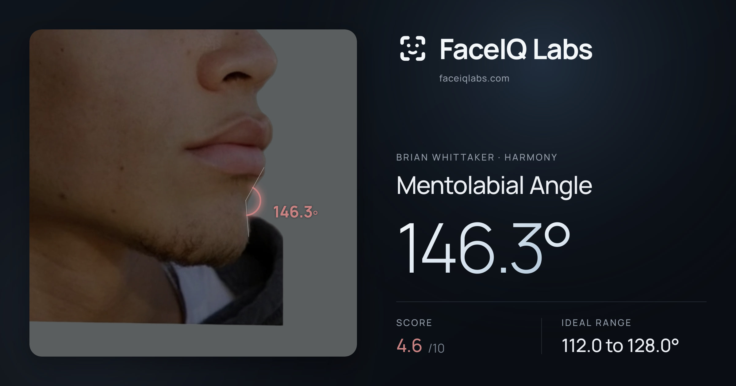 Brian Whittaker Mentolabial Angle: 146.3°, drawn on the photo