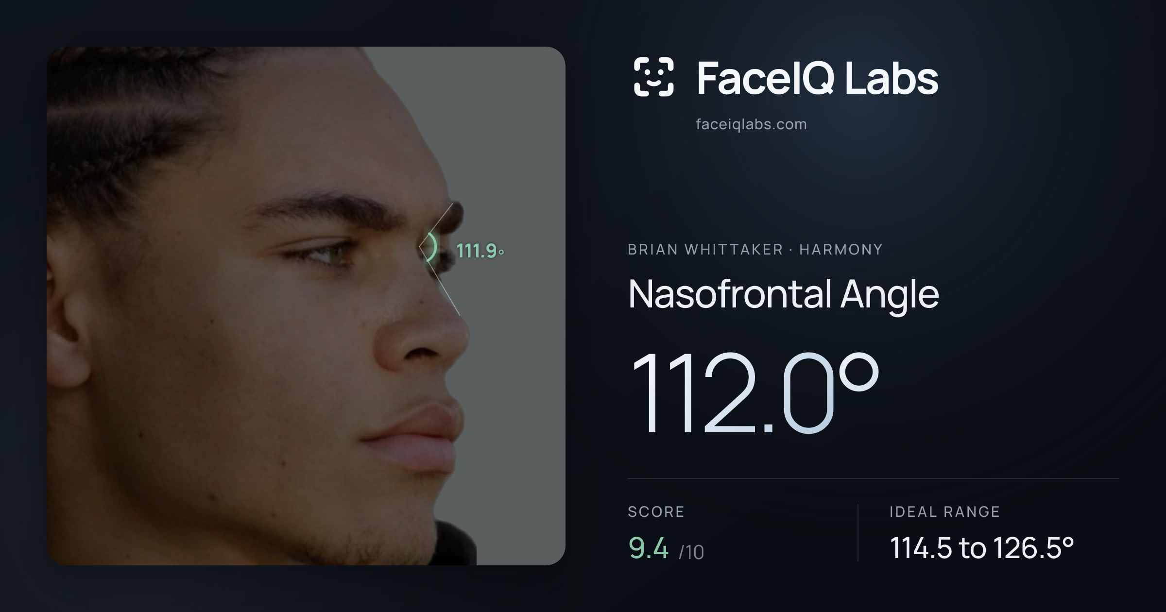 Brian Whittaker Nasofrontal Angle: 112.0°, drawn on the photo