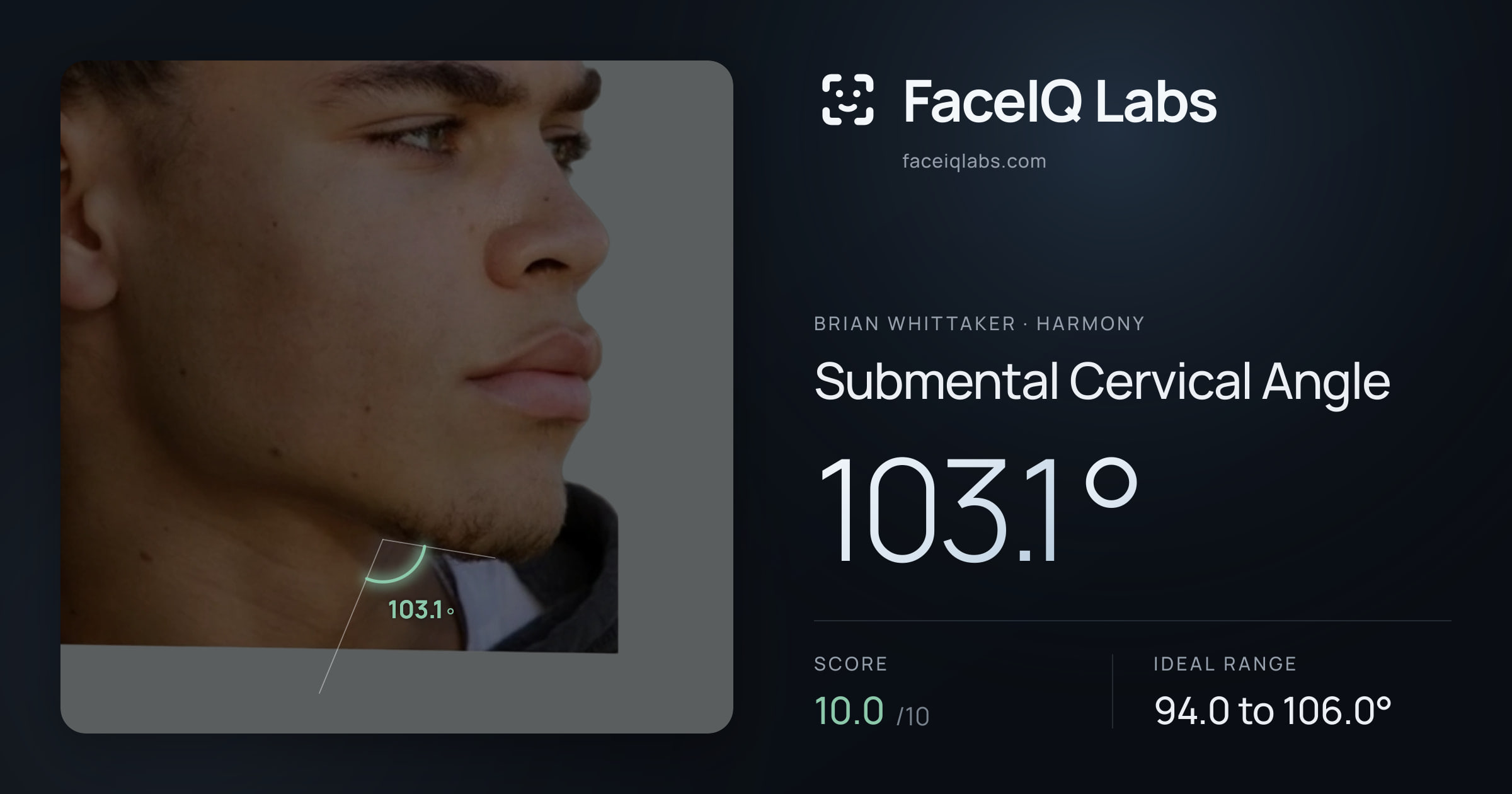 Brian Whittaker Submental Cervical Angle: 103.1°, drawn on the photo
