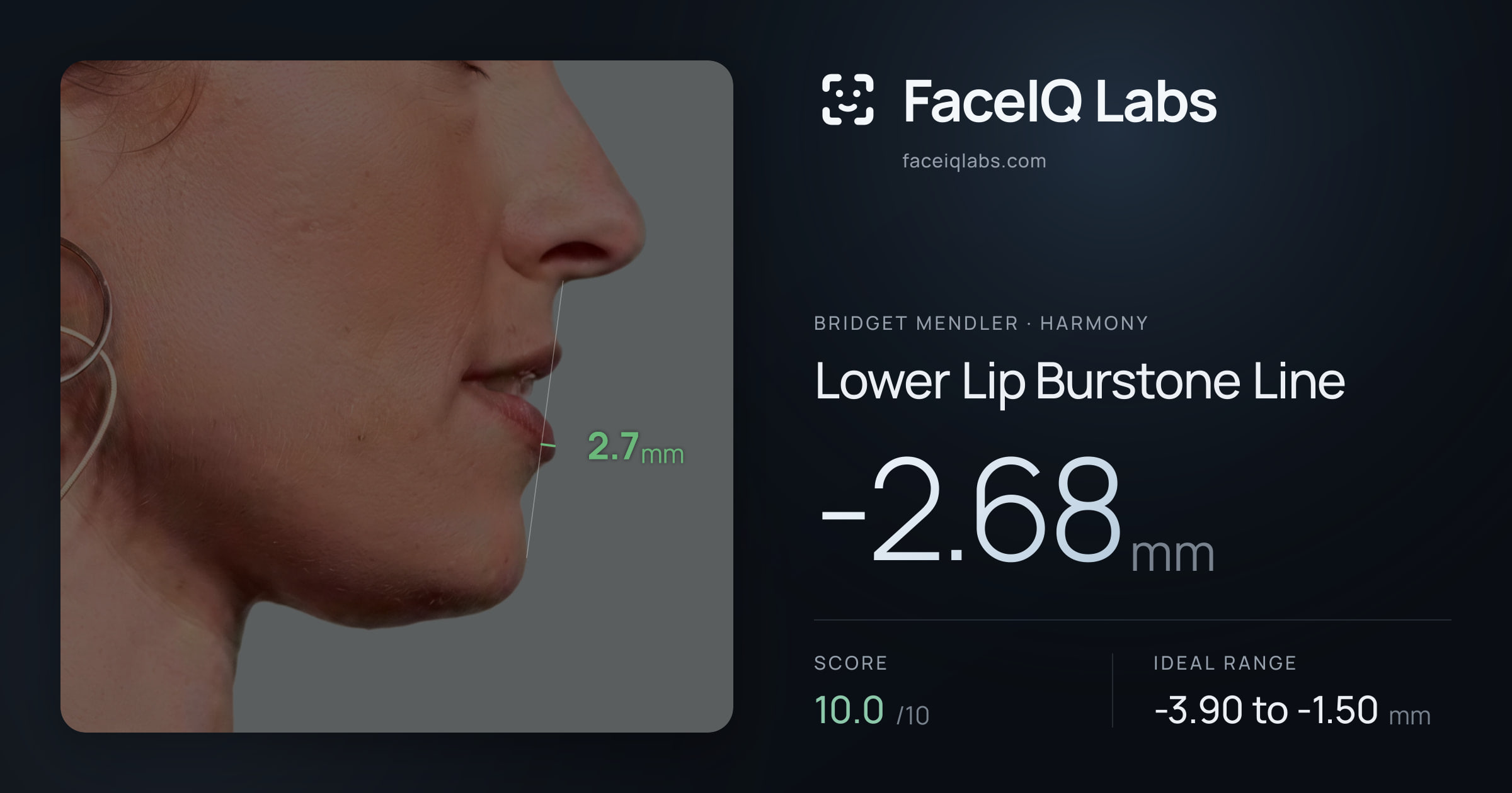 Bridget Mendler Lower Lip Burstone Line: -2.68mm, drawn on the photo