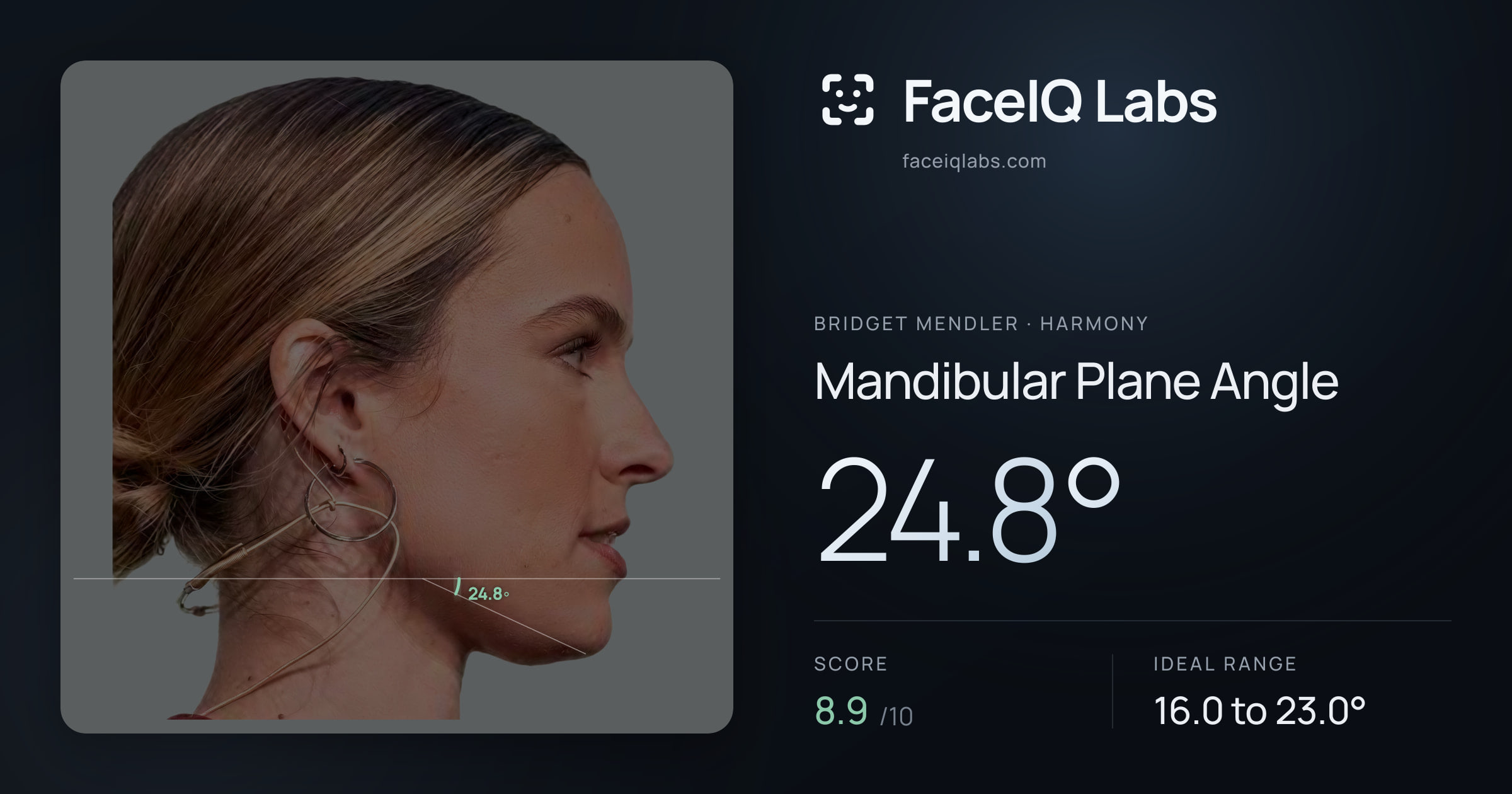 Bridget Mendler Mandibular Plane Angle: 24.8°, drawn on the photo