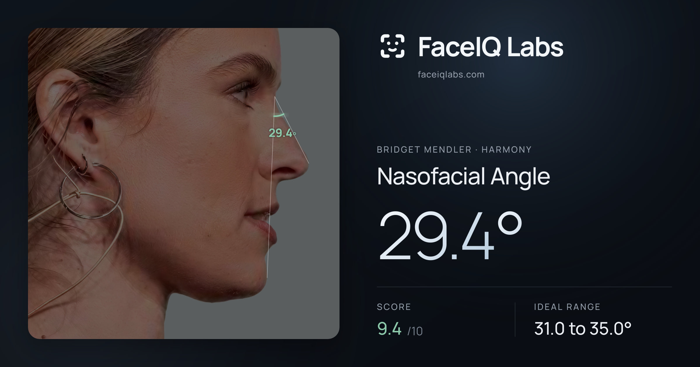 Bridget Mendler Nasofacial Angle: 29.4°, drawn on the photo