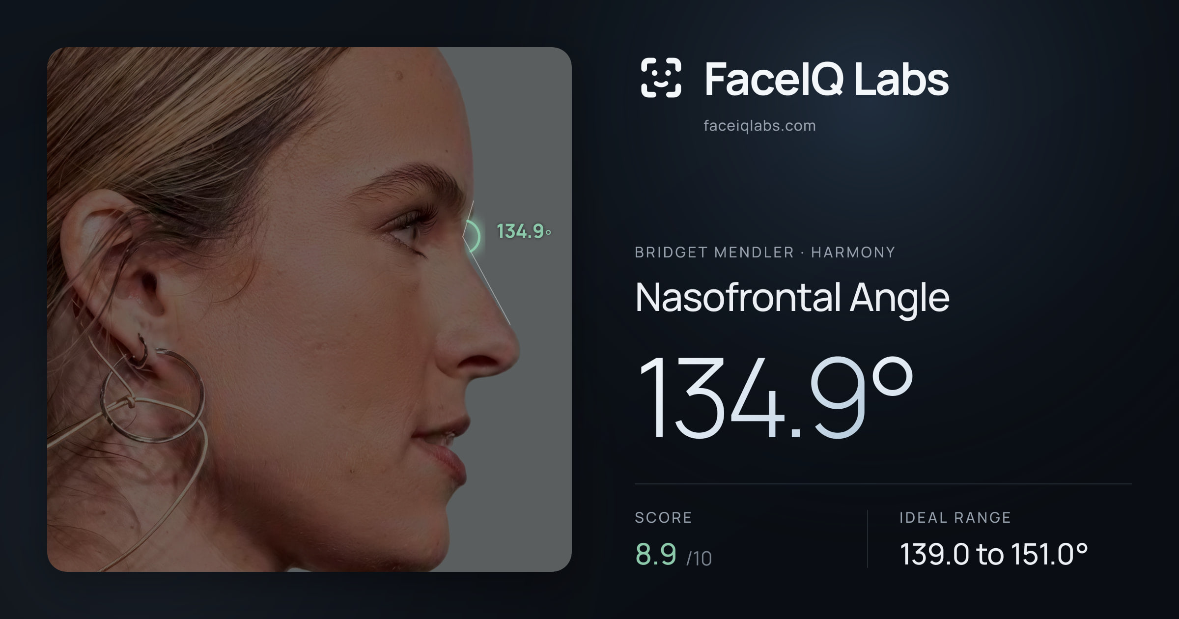 Bridget Mendler Nasofrontal Angle: 134.9°, drawn on the photo