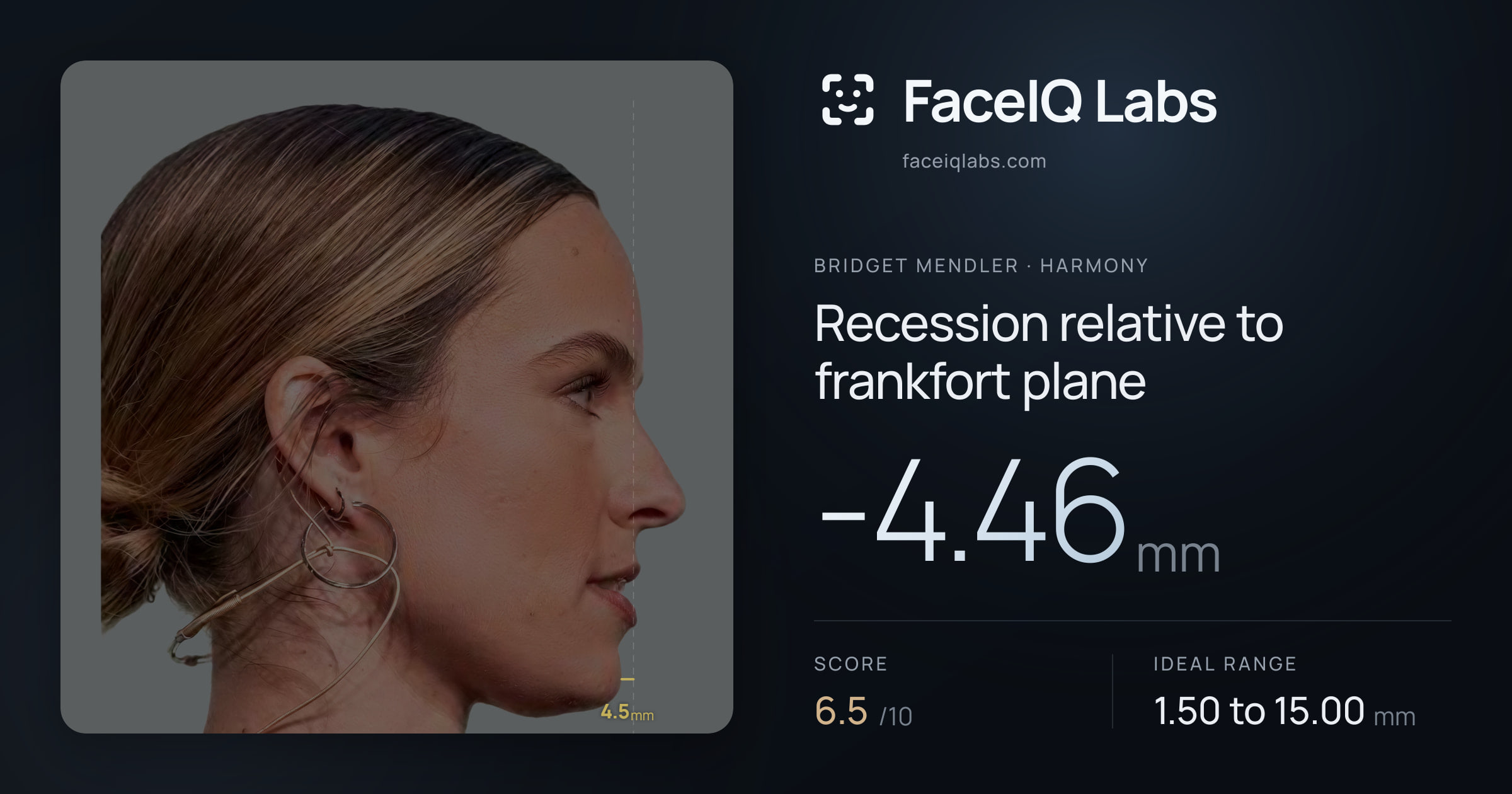 Bridget Mendler Recession relative to frankfort plane: -4.46mm, drawn on the photo