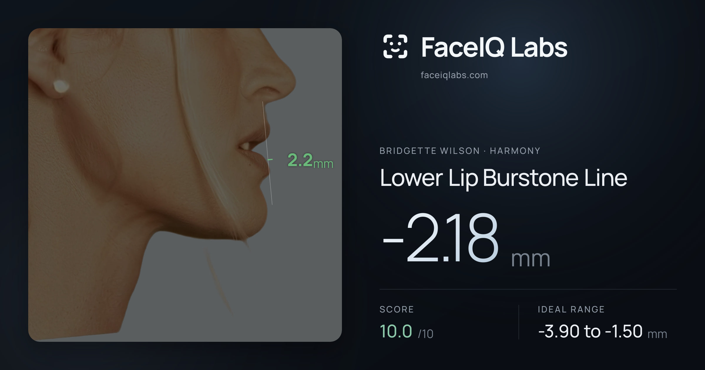 Bridgette Wilson Lower Lip Burstone Line: -2.18mm, drawn on the photo