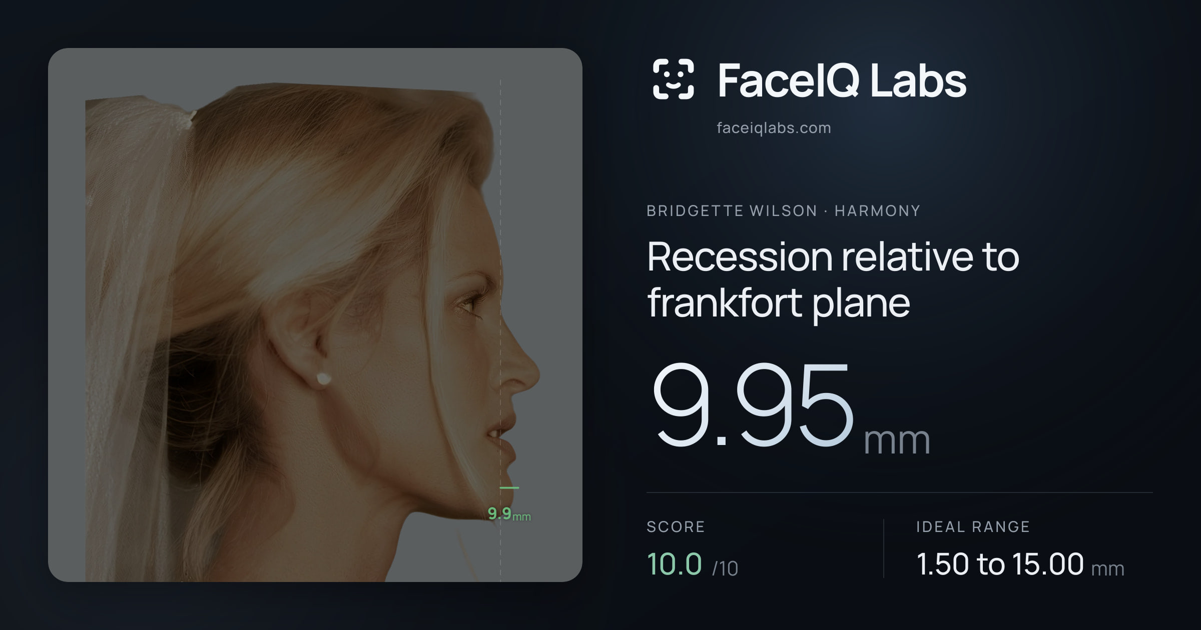 Bridgette Wilson Recession relative to frankfort plane: 9.95mm, drawn on the photo