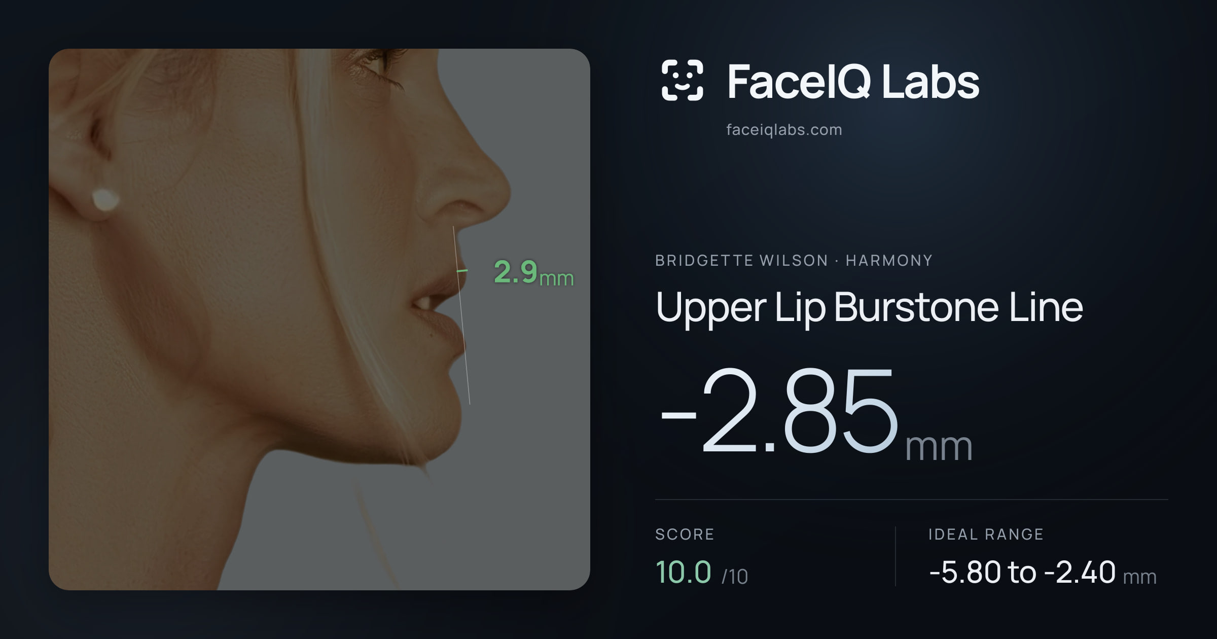 Bridgette Wilson Upper Lip Burstone Line: -2.85mm, drawn on the photo