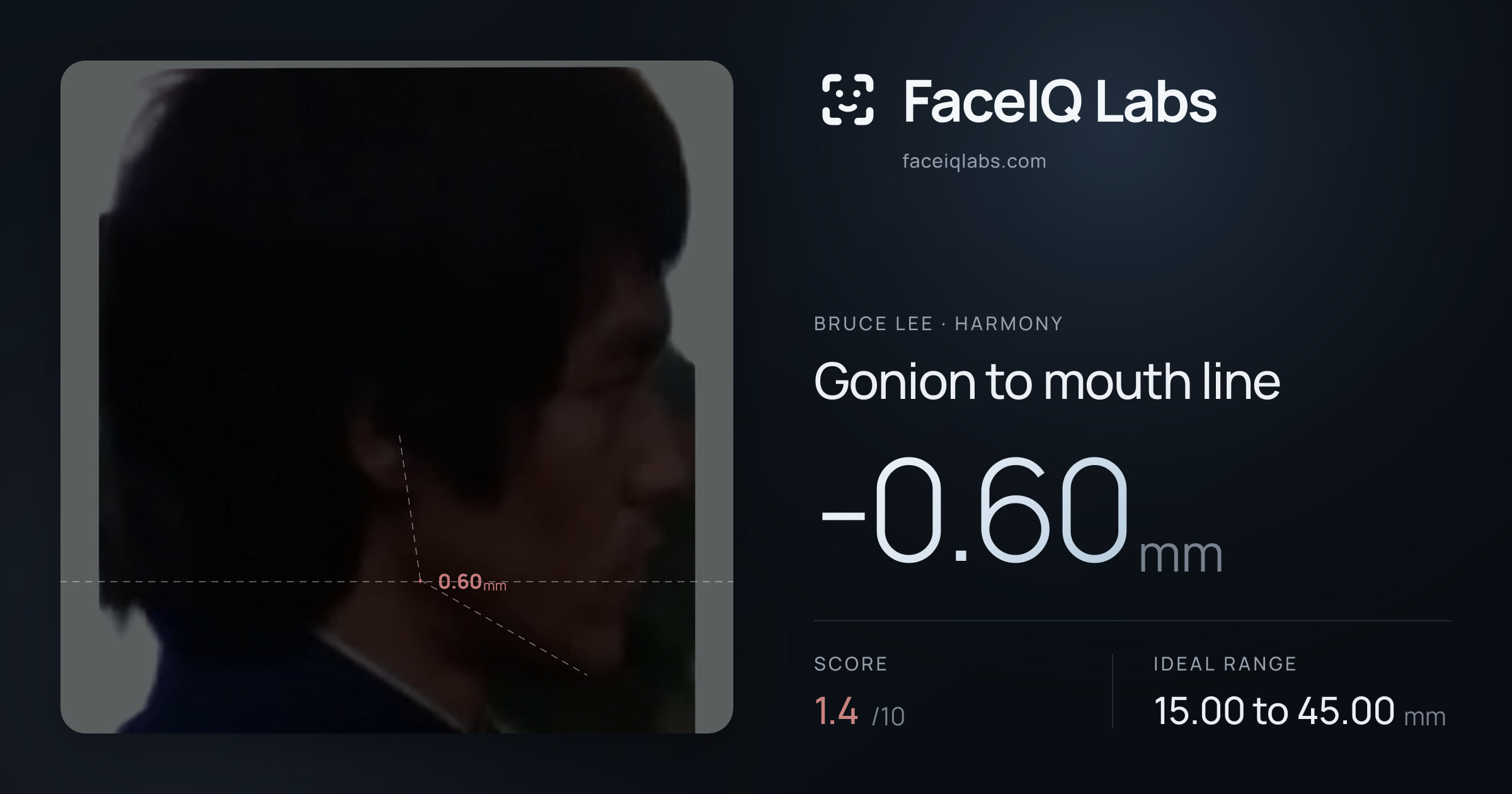 Bruce Lee Gonion to mouth line: -0.60mm, drawn on the photo