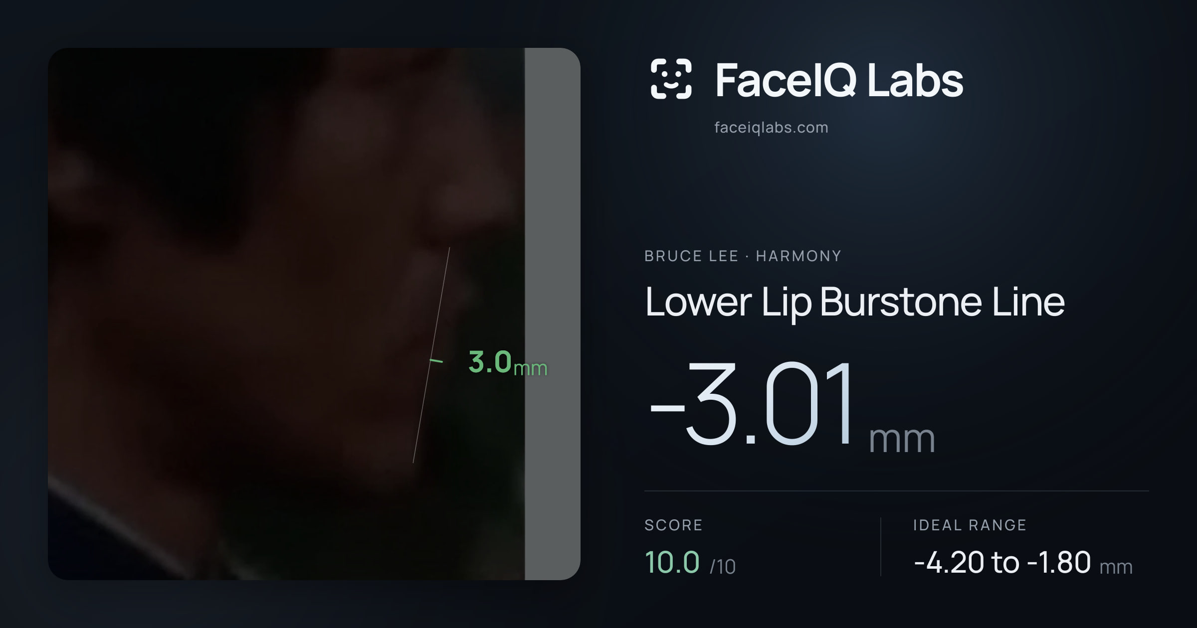 Bruce Lee Lower Lip Burstone Line: -3.01mm, drawn on the photo