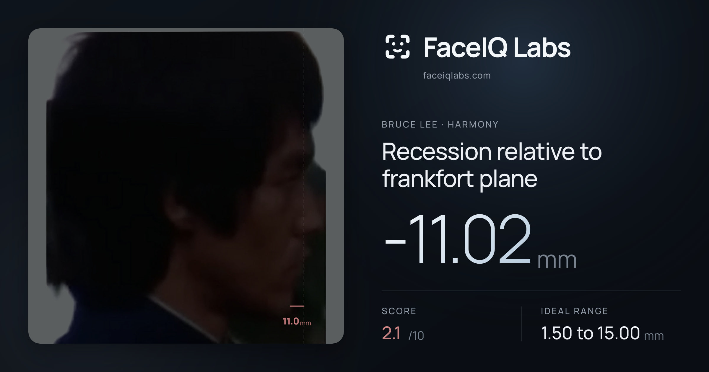 Bruce Lee Recession relative to frankfort plane: -11.02mm, drawn on the photo
