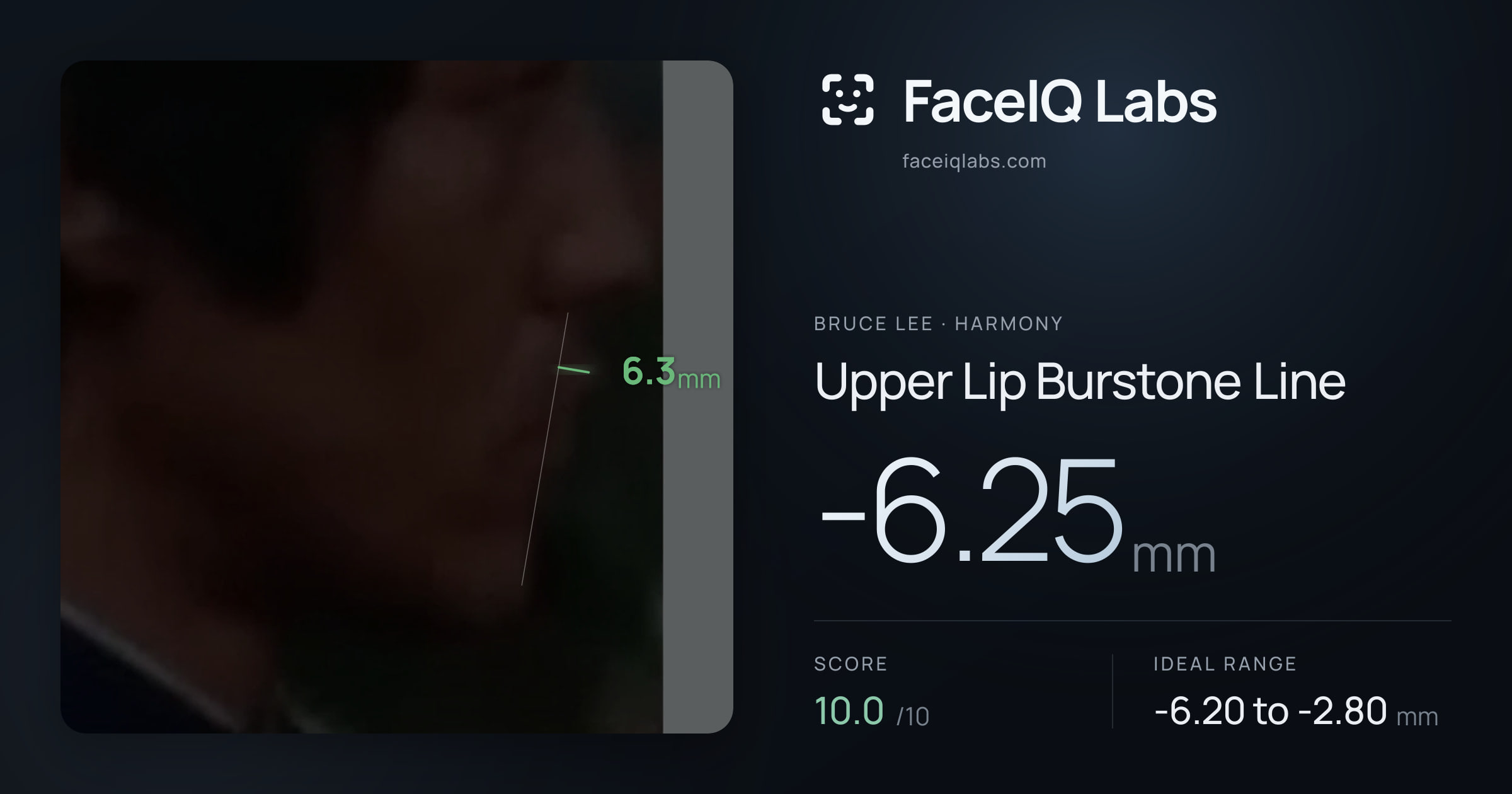 Bruce Lee Upper Lip Burstone Line: -6.25mm, drawn on the photo